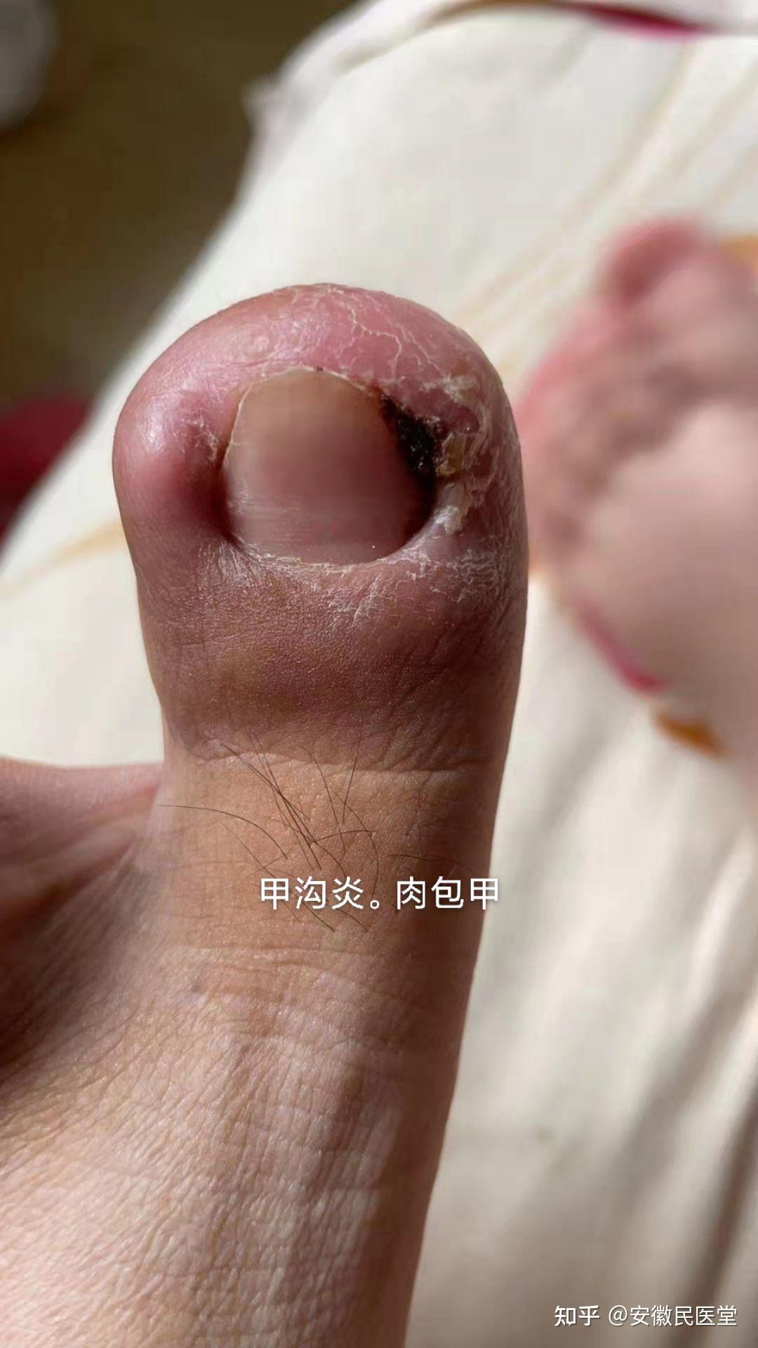 甲沟炎患者日常饮食需要注意什么