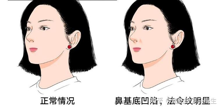 鼻基底凹陷会越来越显嘴凸吗
