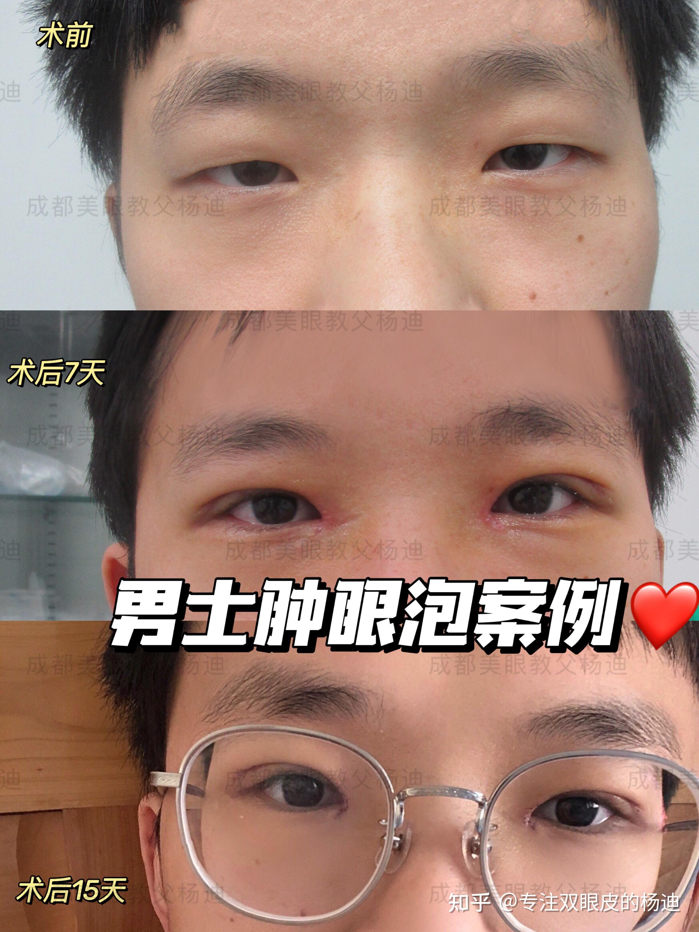男生割双眼皮怎么看?