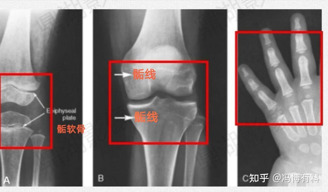 干骺端骺软骨属于软骨连结还是骨性结合呢