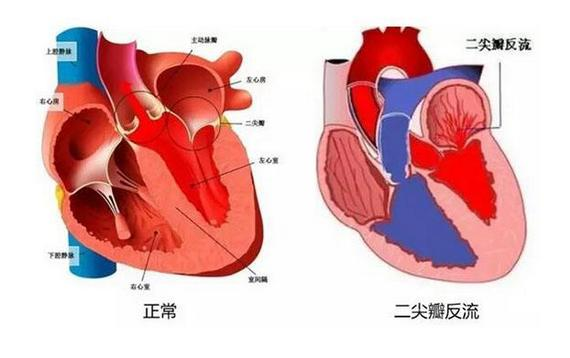 心脏三尖瓣反流 知乎
