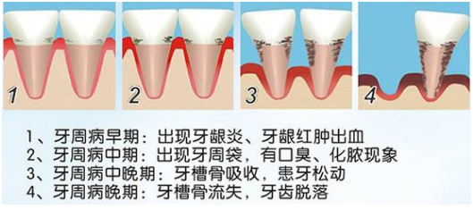 牙周病怎么治疗大家都有什么方法可治疗牙周病