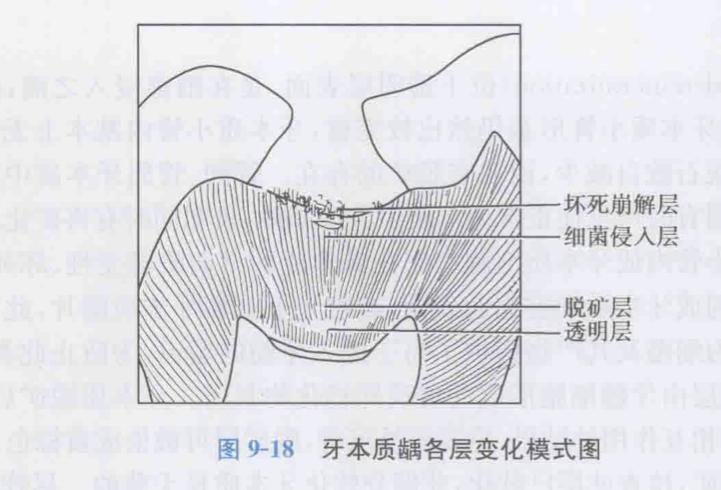 牙本质龋的病理变化过程