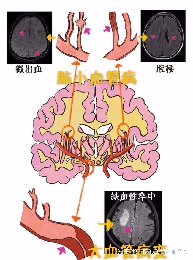 腔梗和脑梗是什么