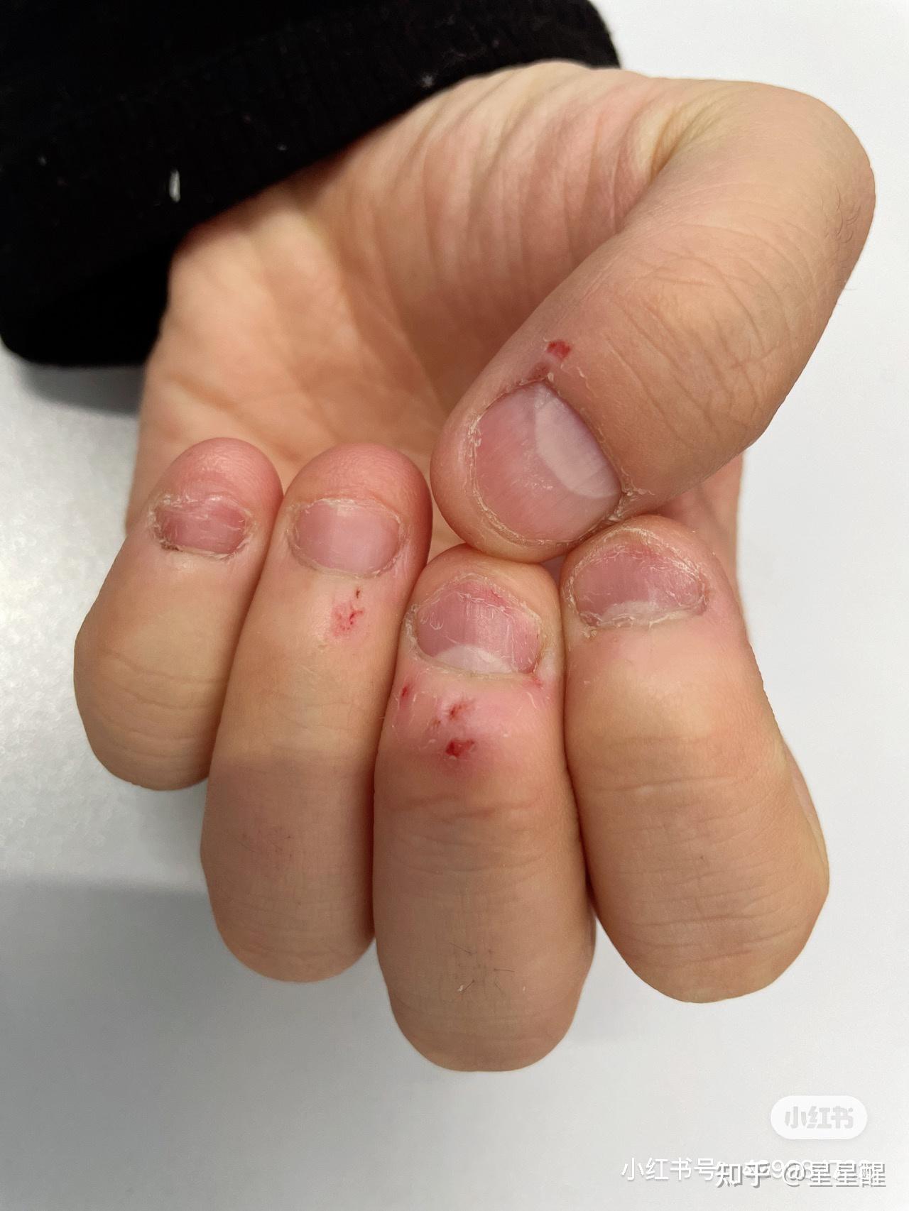 女生喜欢咬手(倒刺和皮,指啃指甲怎么办 知乎