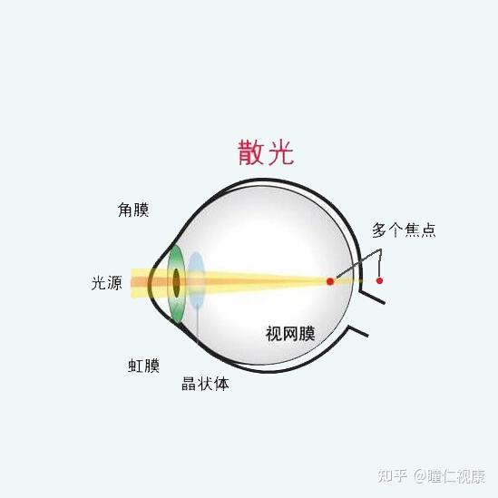 散光能做激光手术吗