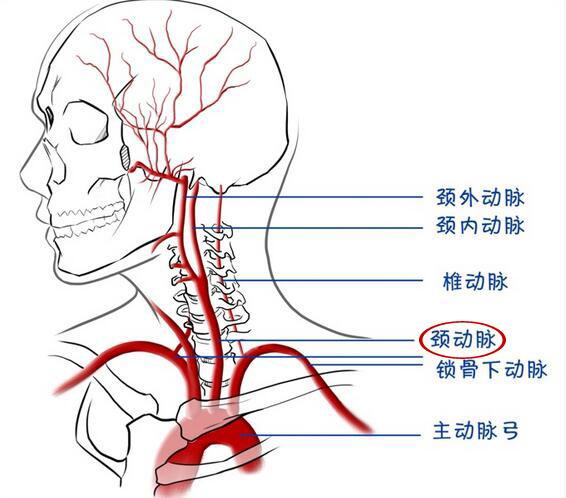 颈动脉狭窄怎么办