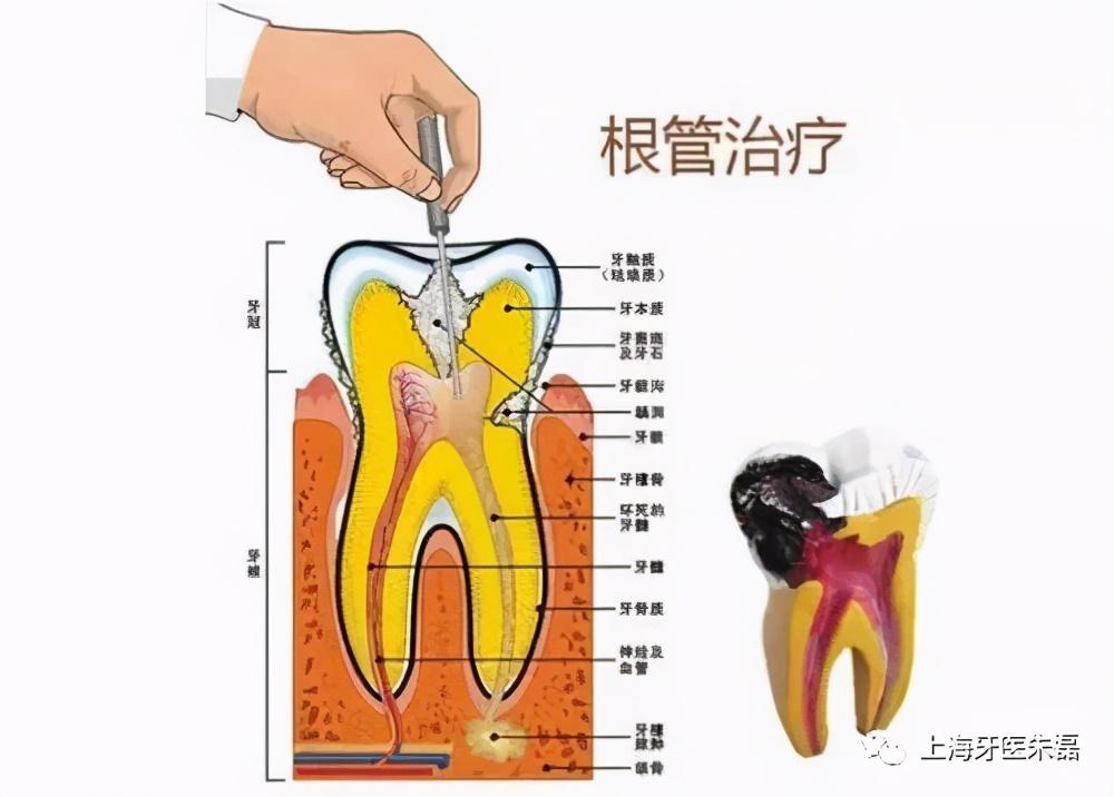 根管再治疗