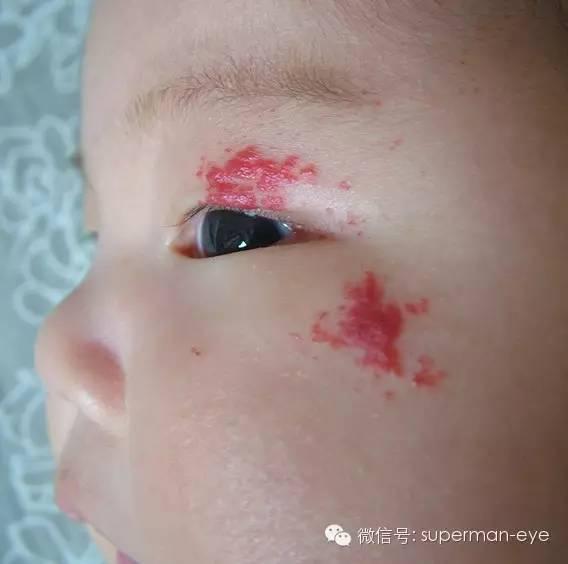 Capillary Hemangioma 毛细血管瘤 - 知乎