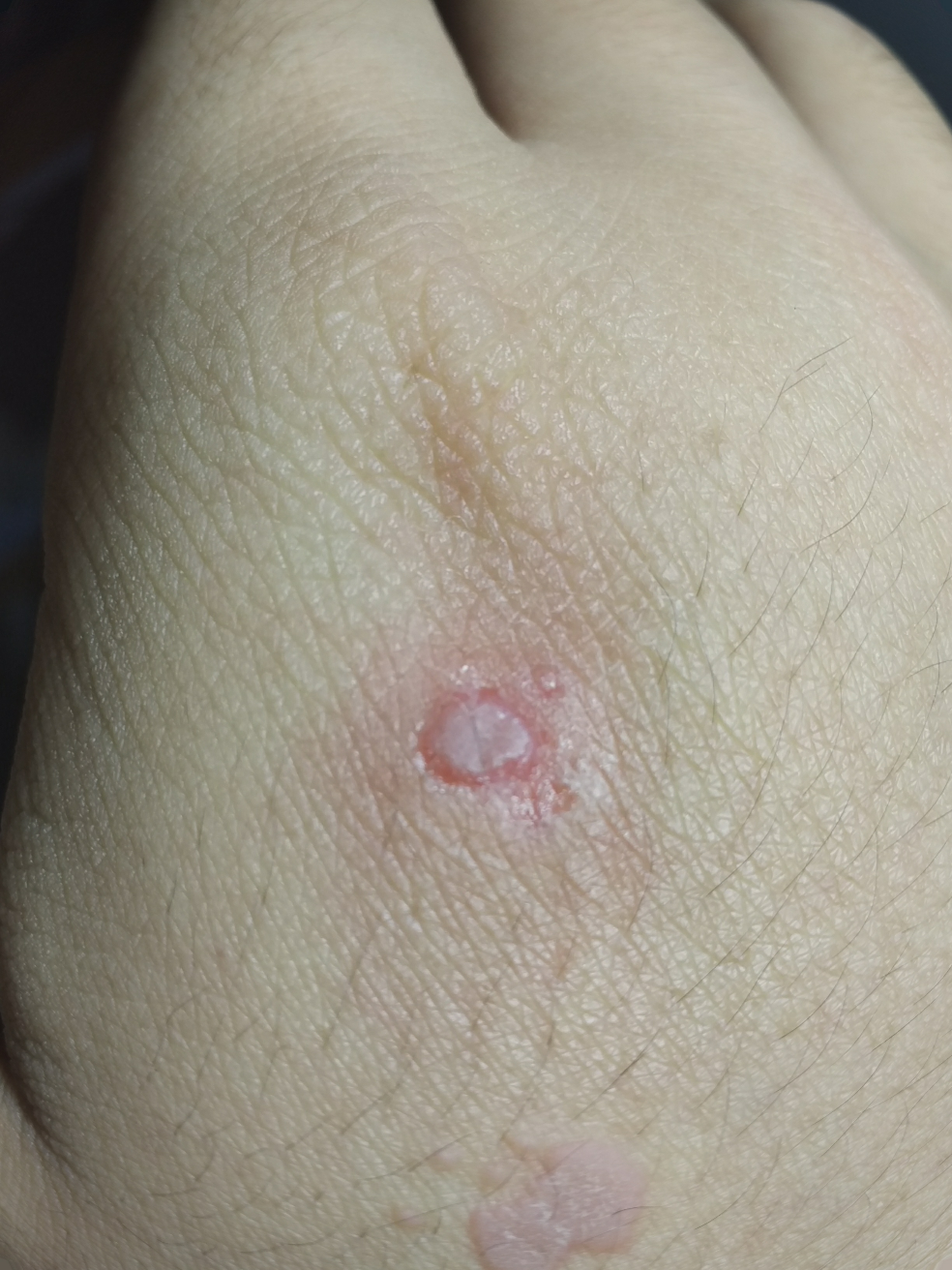 手背上这个东西是扁平疣吗我该怎么办