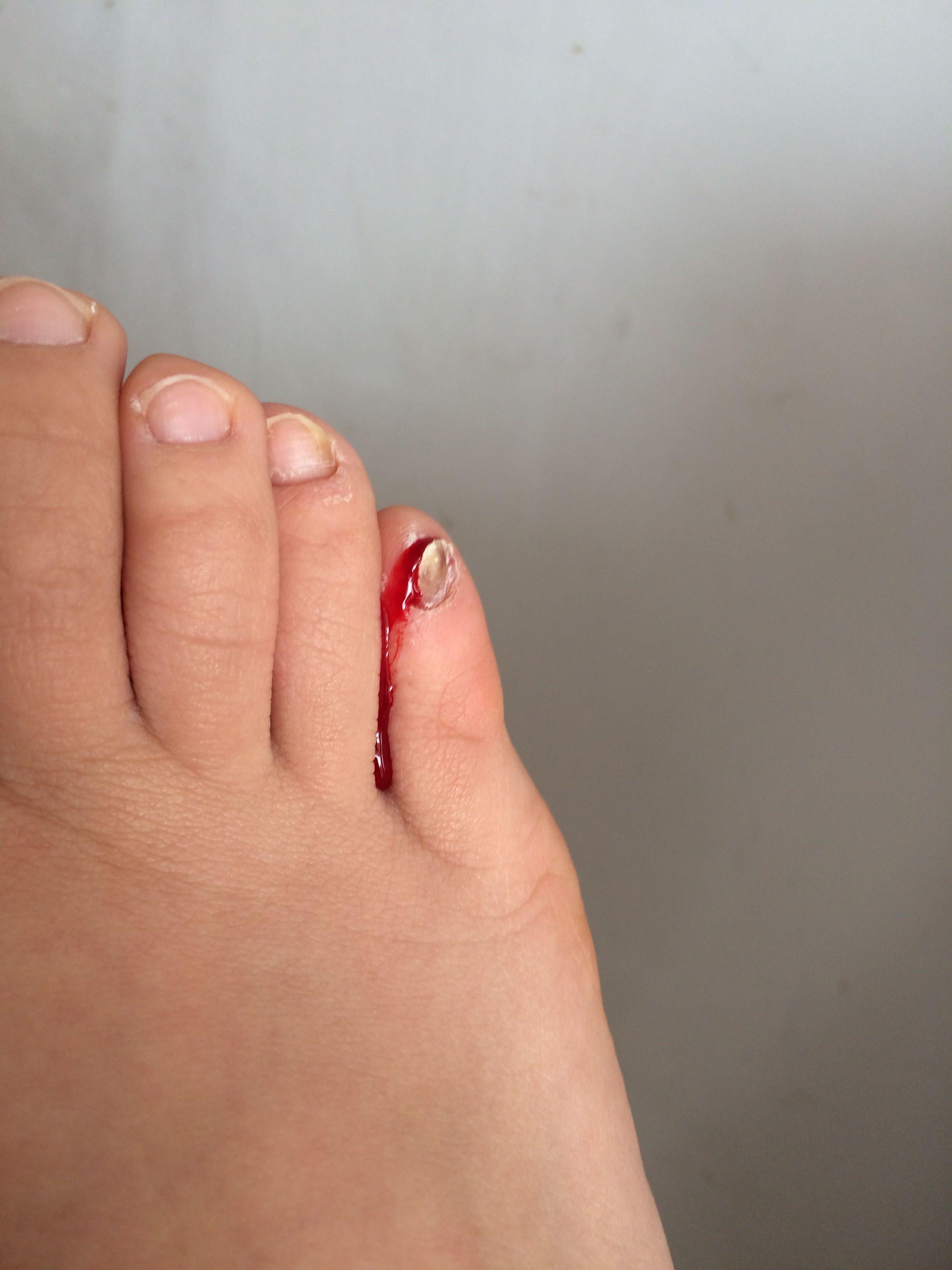 脚趾踢到桌角的痛算几级疼痛? - 知乎