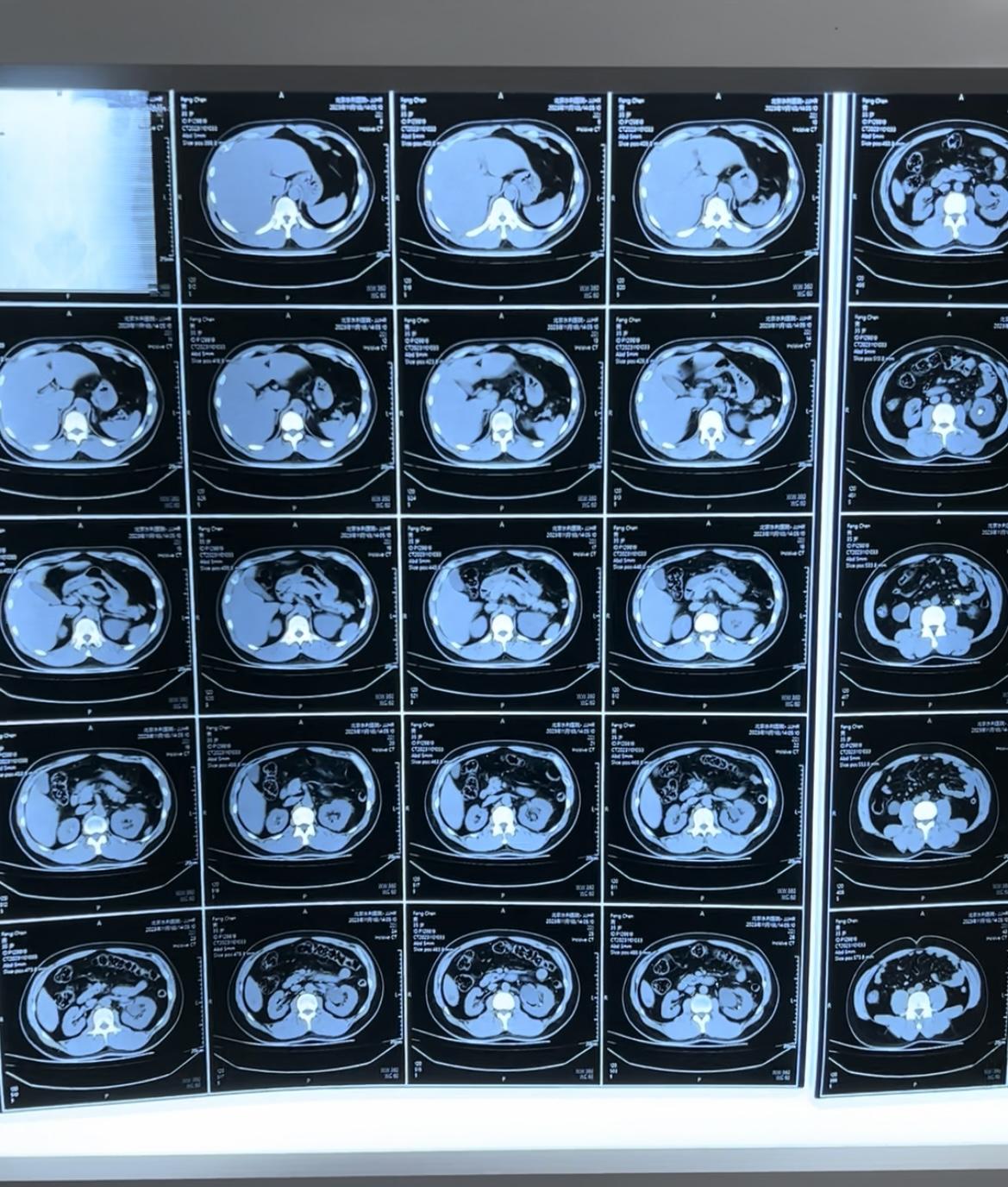 泌尿外科陈海涛 的想法: 肾结石检查,做b超和ct检查,有什么区别