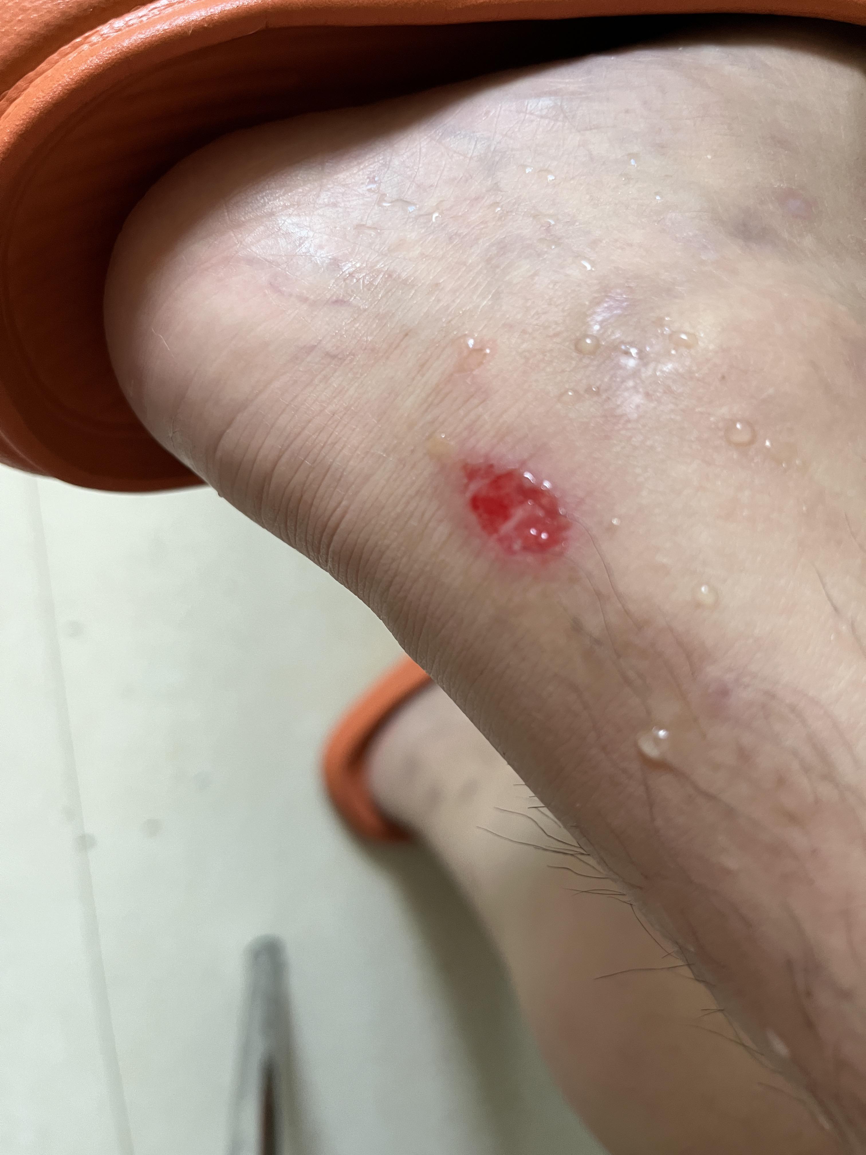 阿宝宝 的想法: 脚踝总痒一抓就破破了之后,会定住一层软软的壳,但不