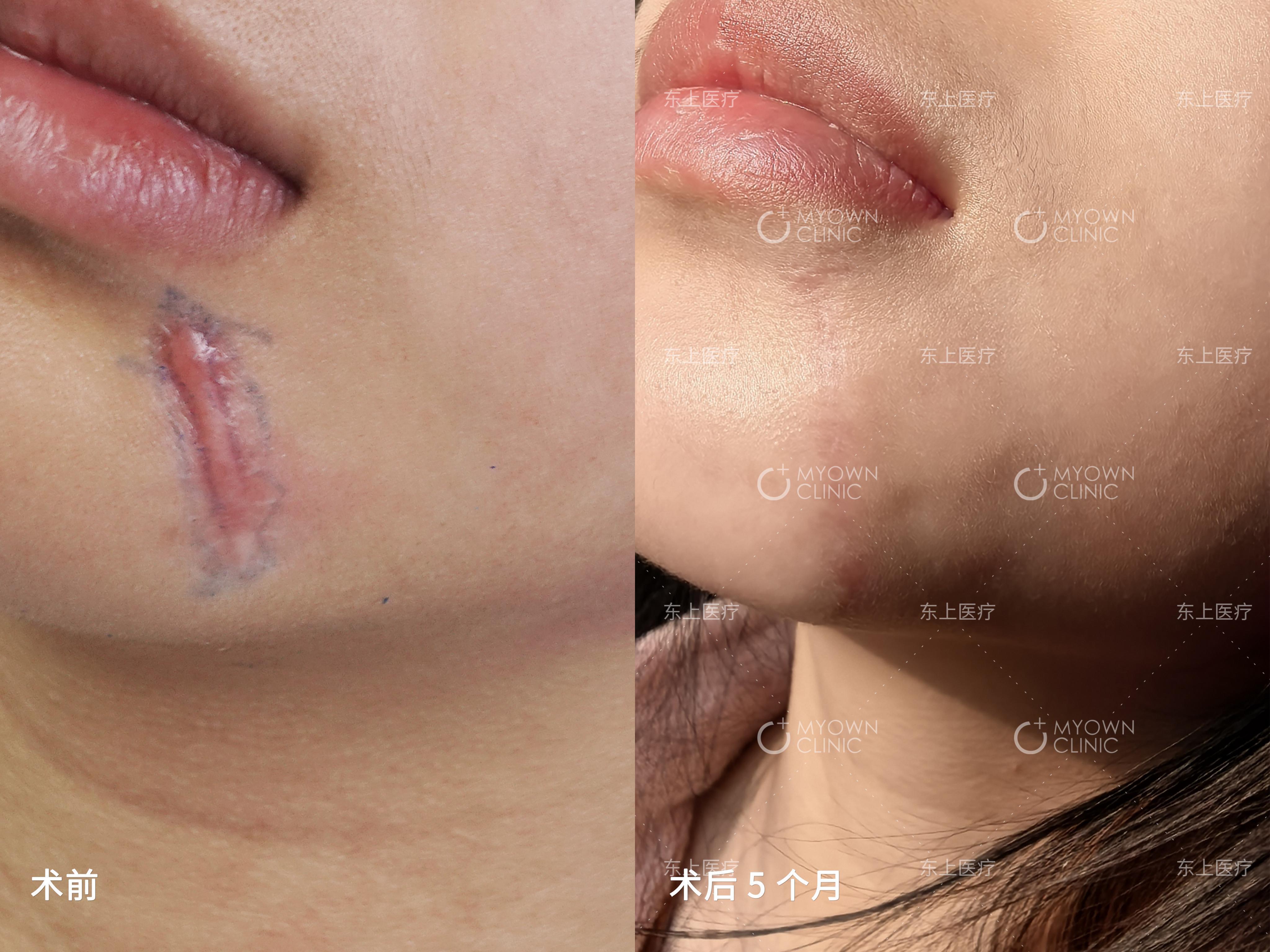 下颌增生性疤痕切除缝合术后5月
