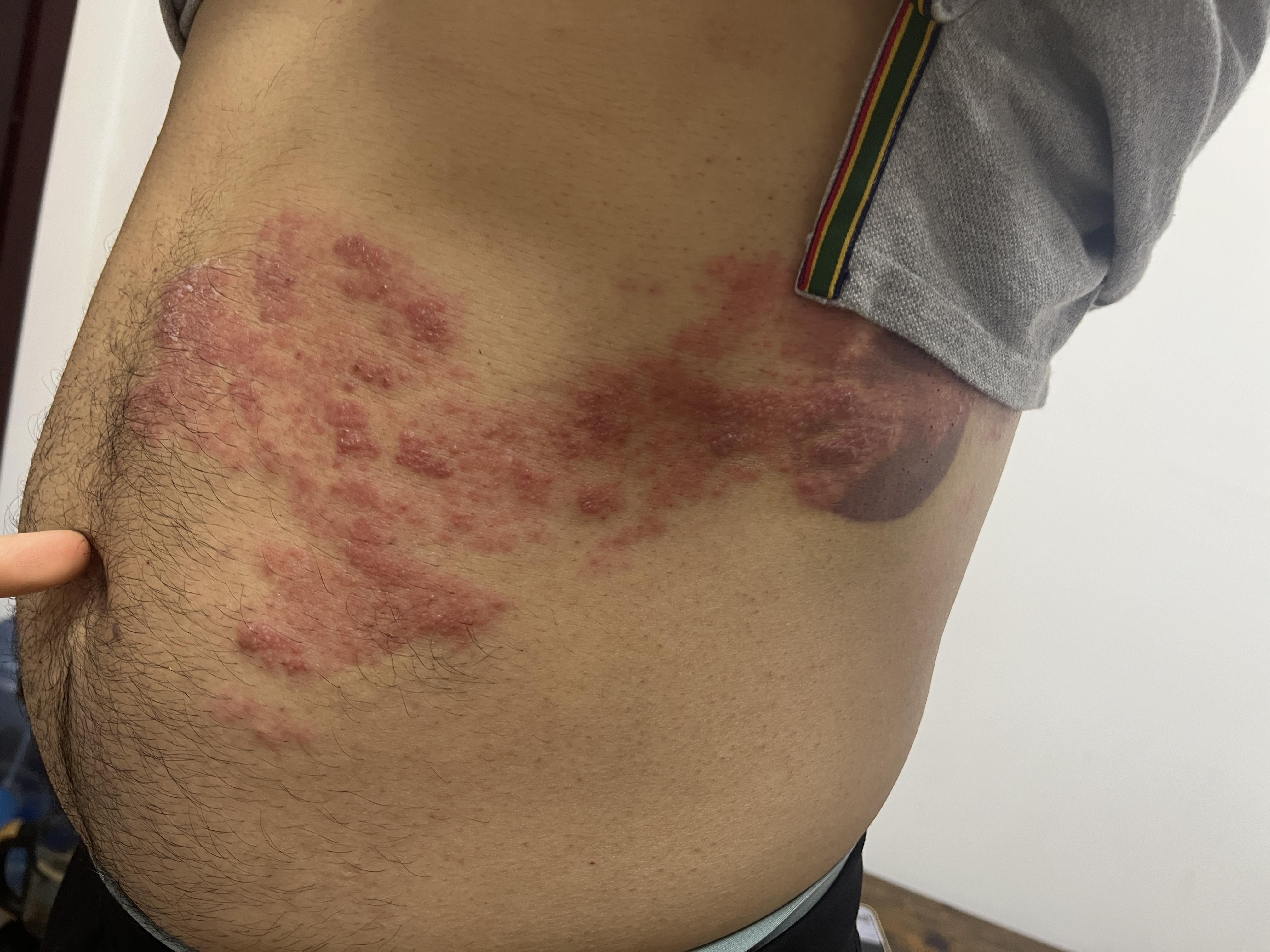 的想法: 很典型的带状疱疹,祖国医学称为"缠腰火丹",俗称"蛇串疮"