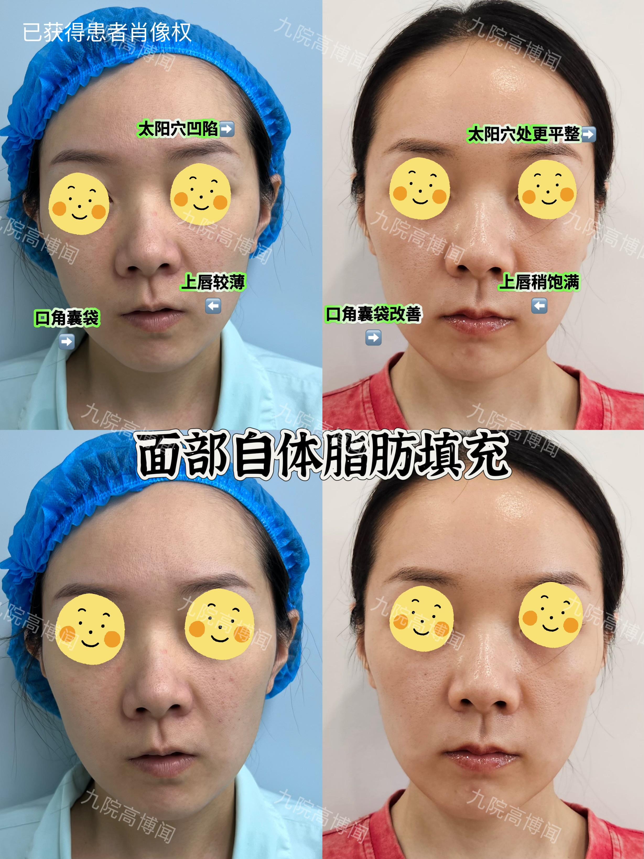 上海九院整形高博闻 的想法: 自体脂肪填充面部3个月:太阳穴凹陷