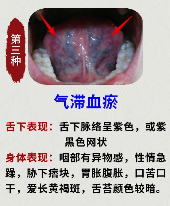 中医男科周东 的想法: 身体哪里有瘀堵,看看舌下就知道!