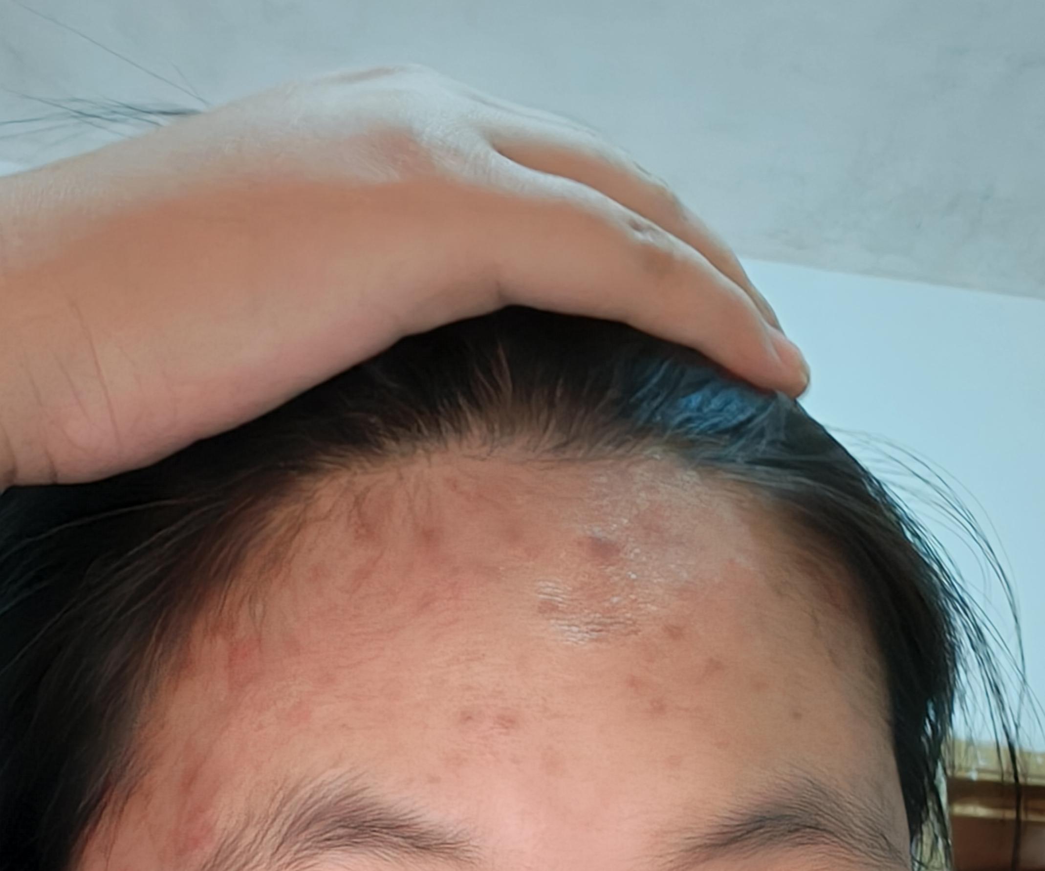 额头长痘为什么会头痛为什么在线