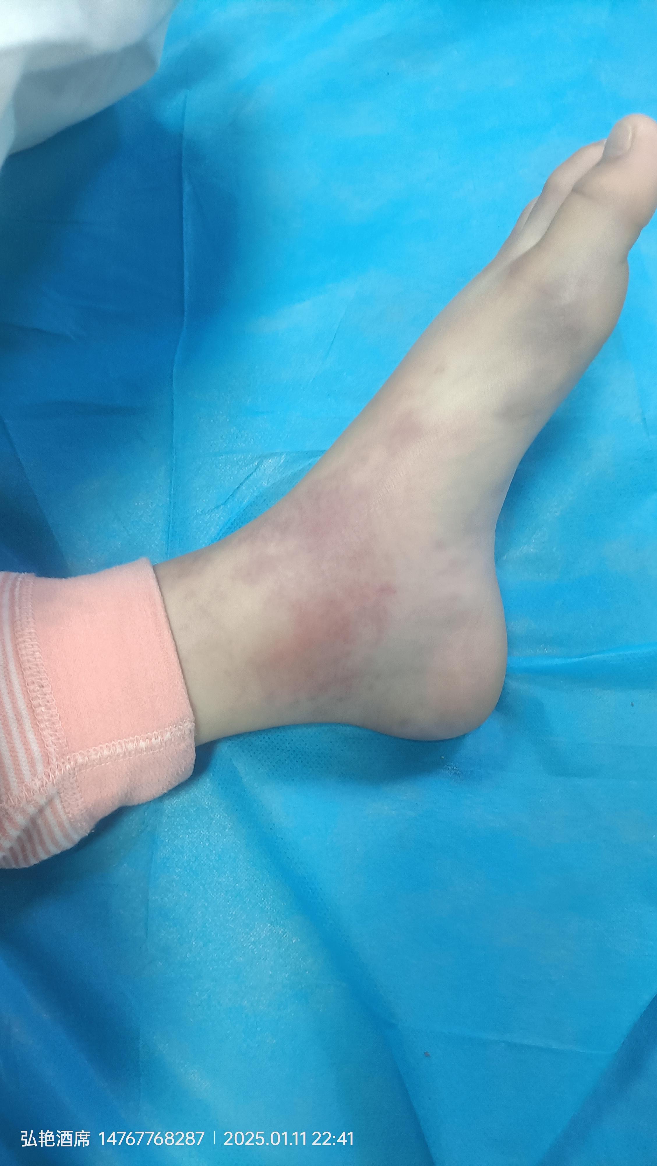 出现这种过敏性紫癜会怎么样?
