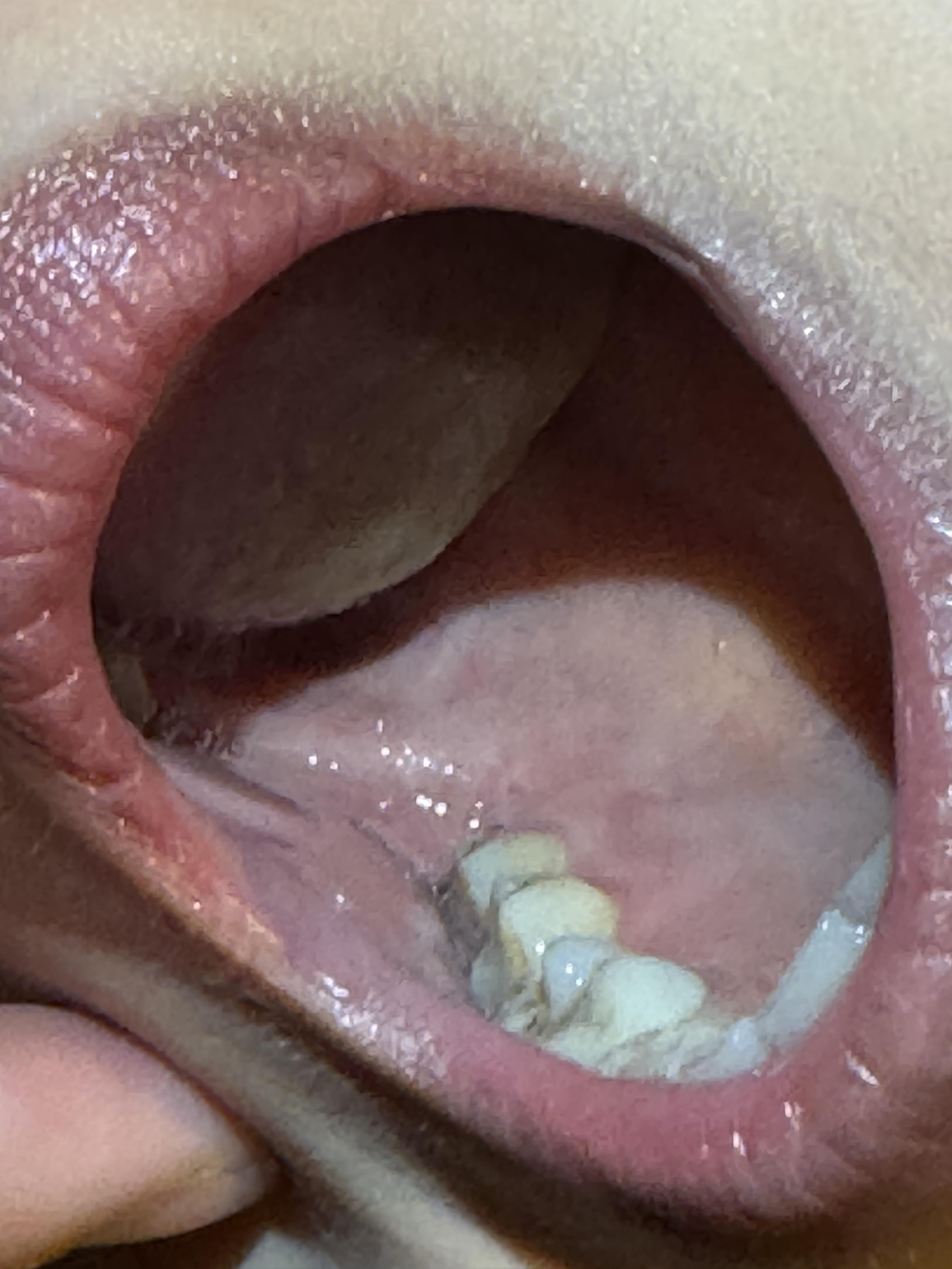 哪些疾病可以引起口腔溃疡3月20日是世界口腔健康日卫健委曾提醒长