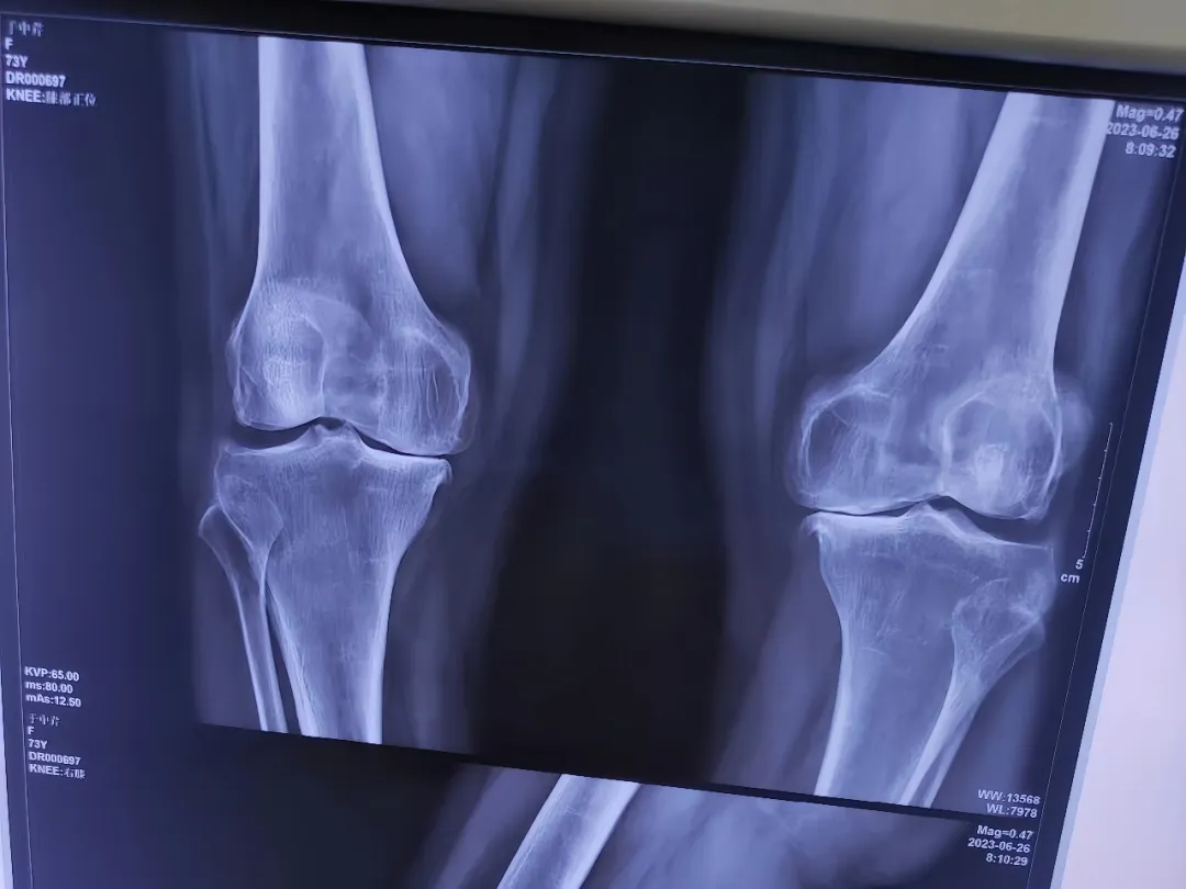 膝关节间隙变窄,这一医学影像学的发现,往往预示着膝关节内部结构