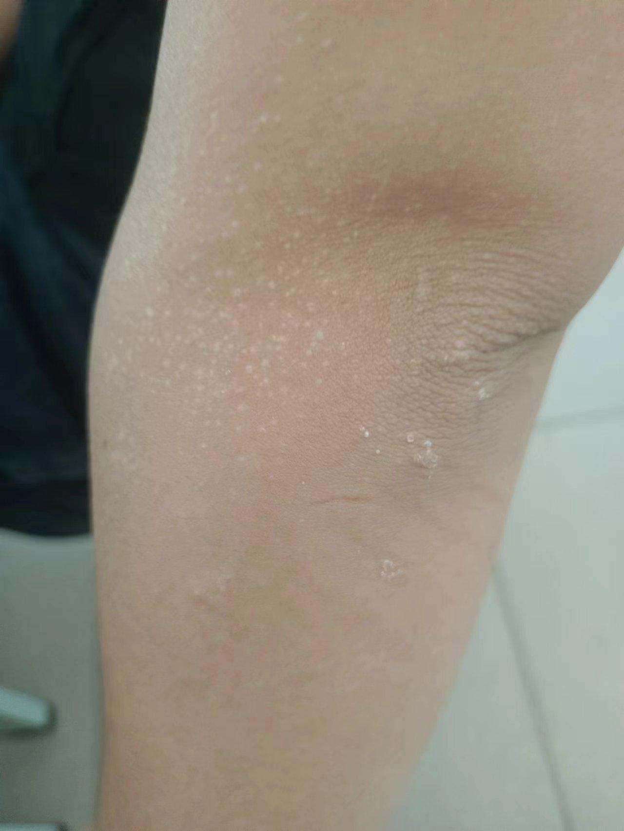 看不出来的病大家能看出来这是怎么了吗之前在太阳下暴晒几日过些日子