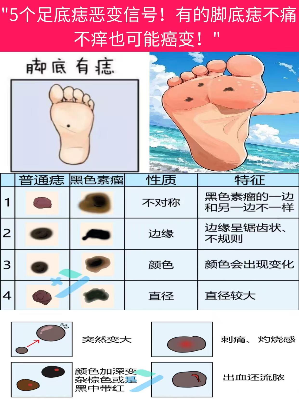 脚底痣看似普通,但暗藏危机!20