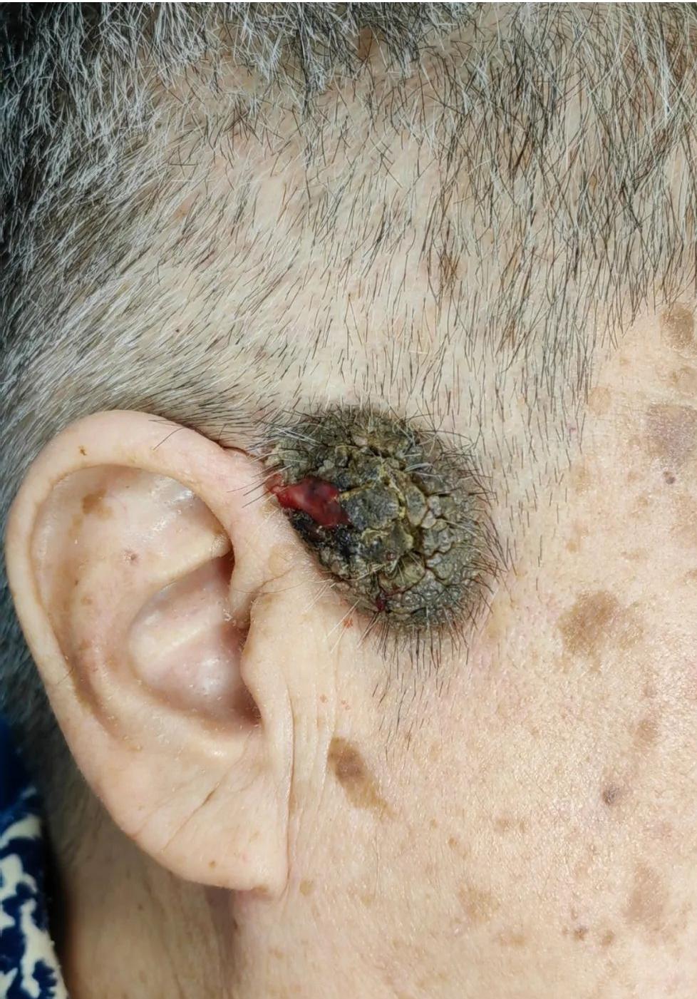 脂溢性角化是一种最常见的表皮良性肿瘤,好