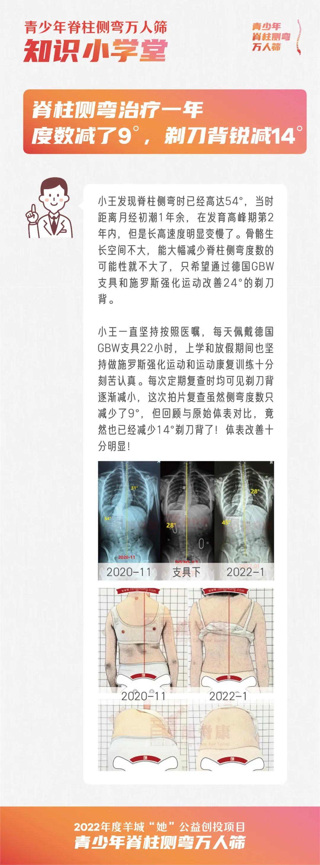 龙脊康杜惠玲 的想法: 青少年脊柱侧弯万人筛|脊柱侧弯治疗一年,剃刀背锐减14°! - 知乎