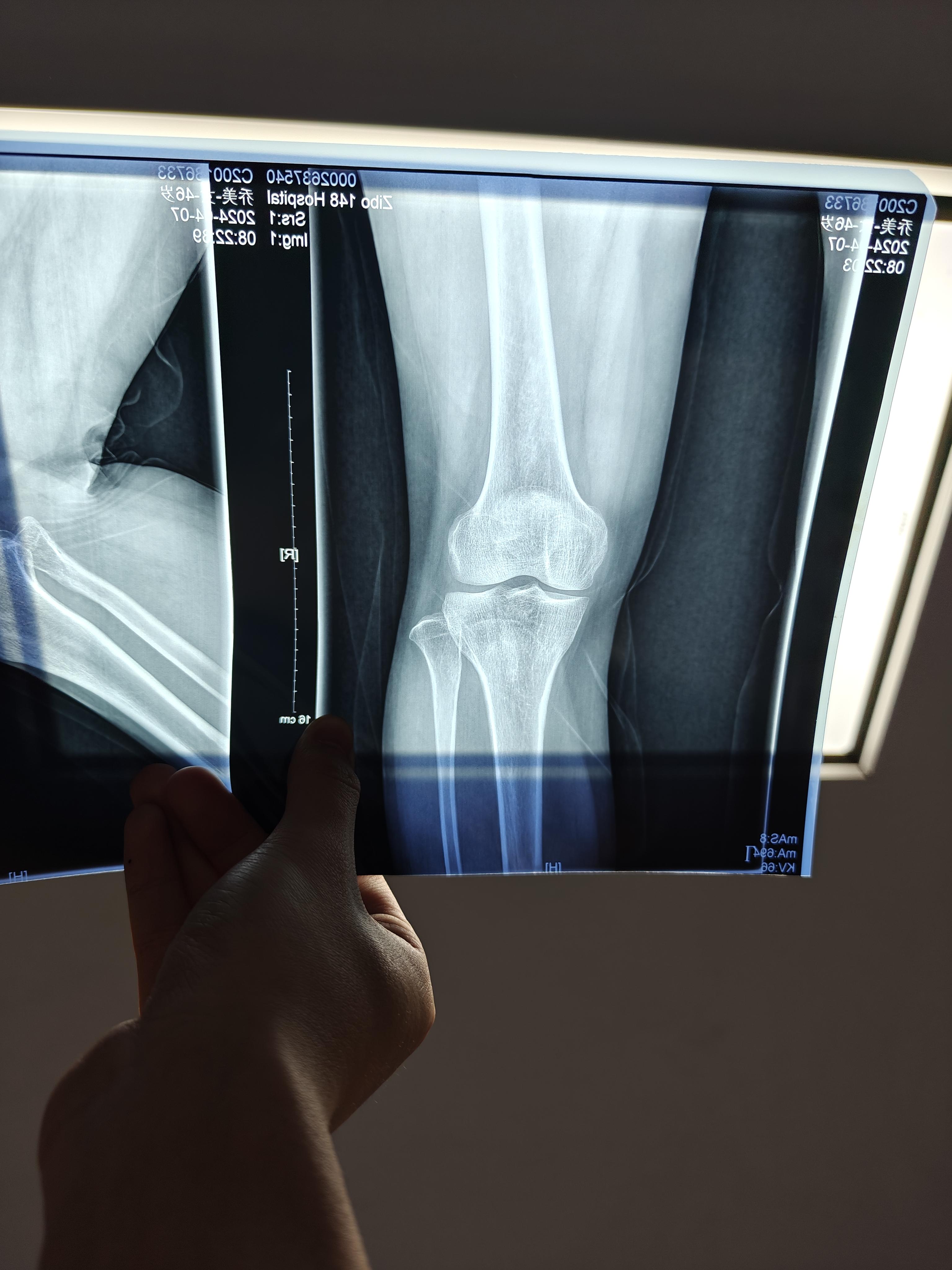 哈拉邵 的想法: 求专业骨科医生看看