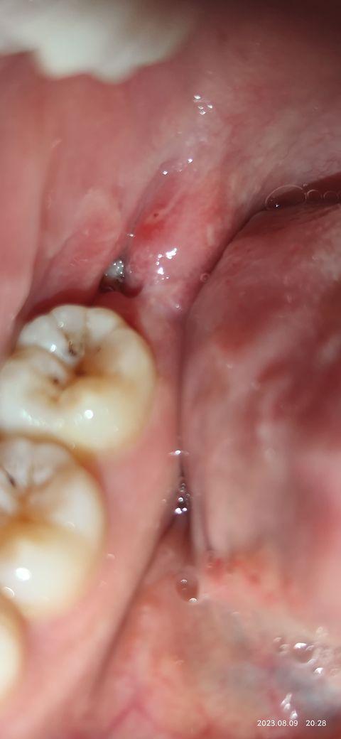 拔完智齿后有一个小洞上周日拆的线今天周三突然发