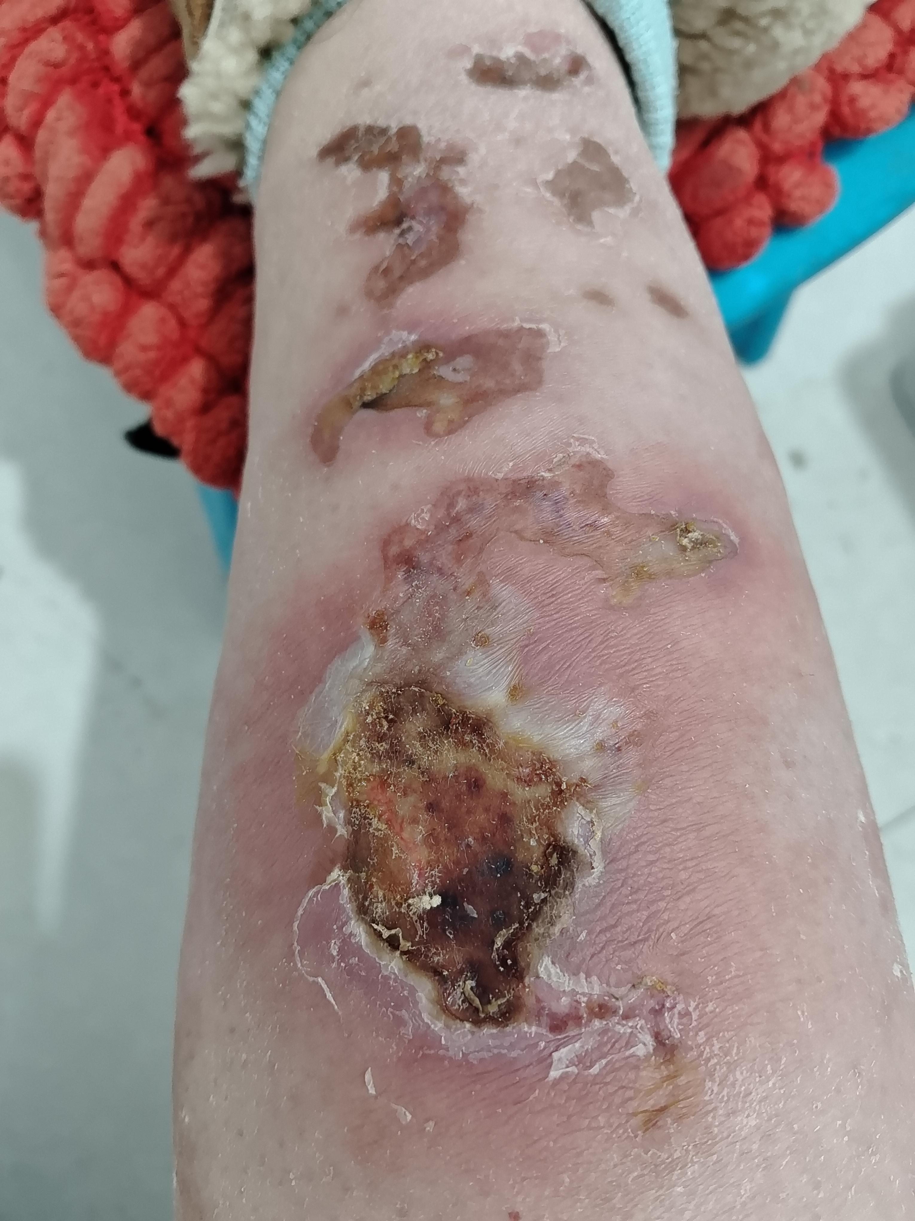 举世无双 的想法: 腿被热水袋烫伤的痊愈过程