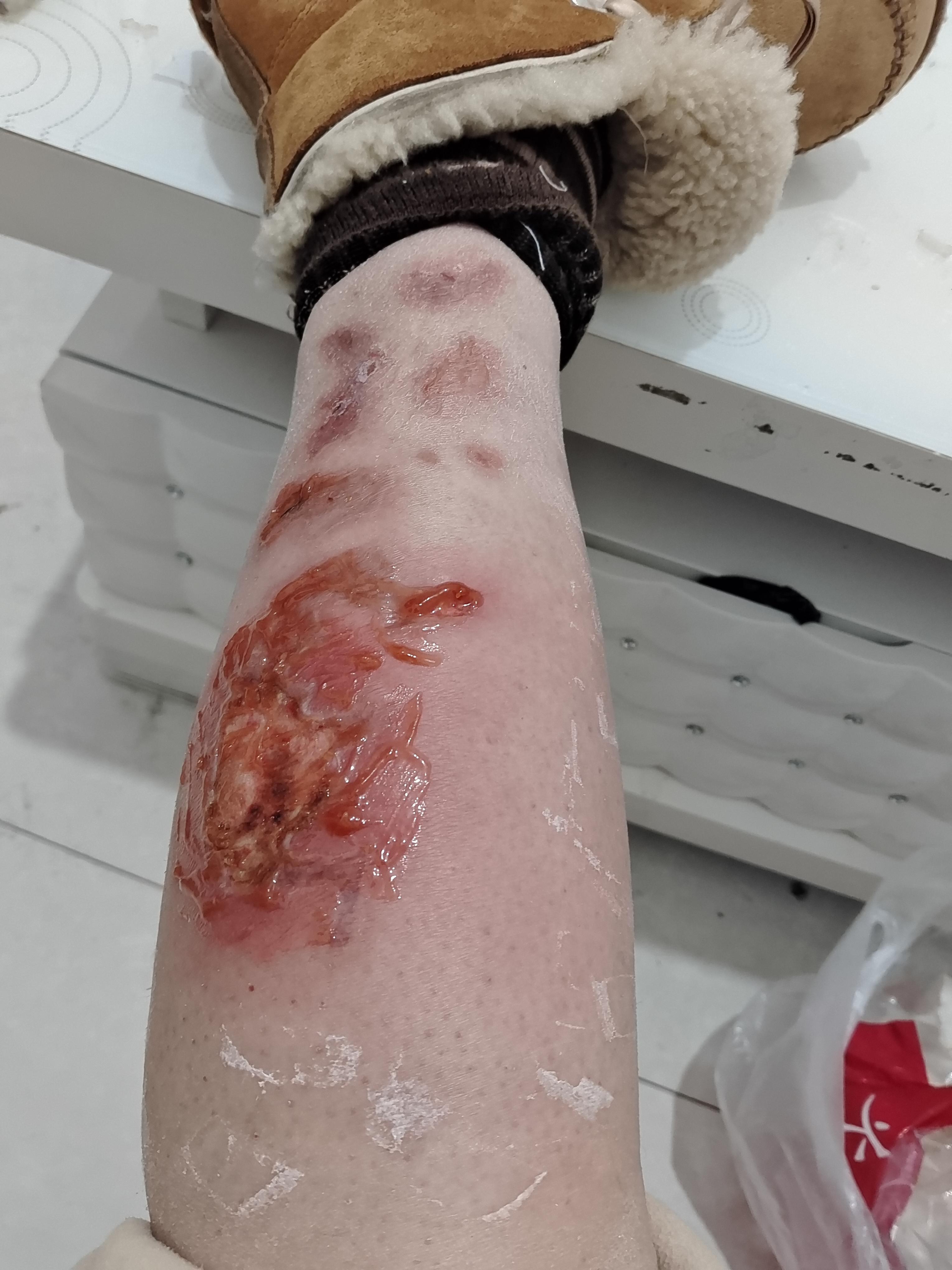 举世无双 的想法: 腿被热水袋烫伤的痊愈过程