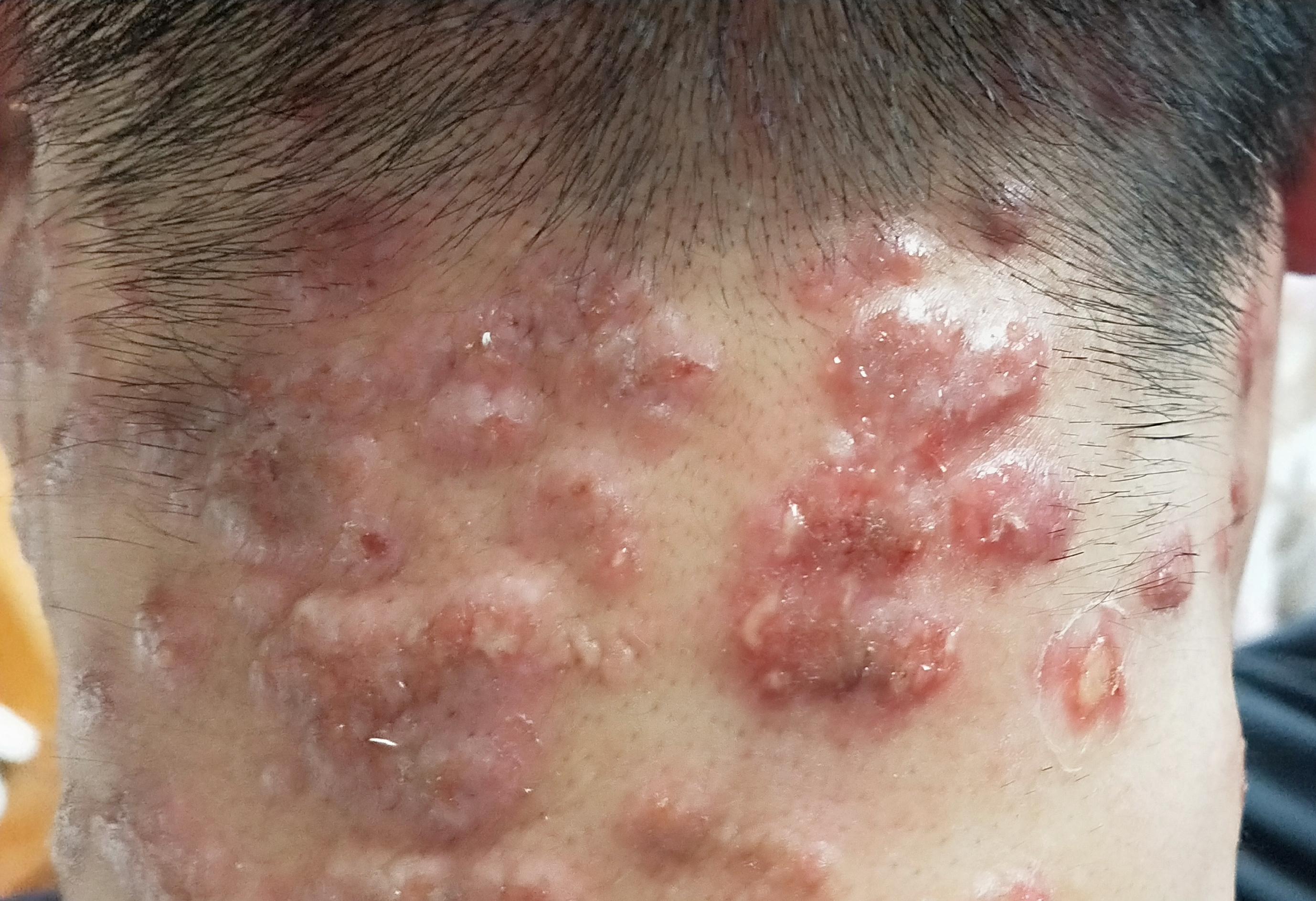 调皮有道李志忠 的想法: 结节性痒疹食疗方