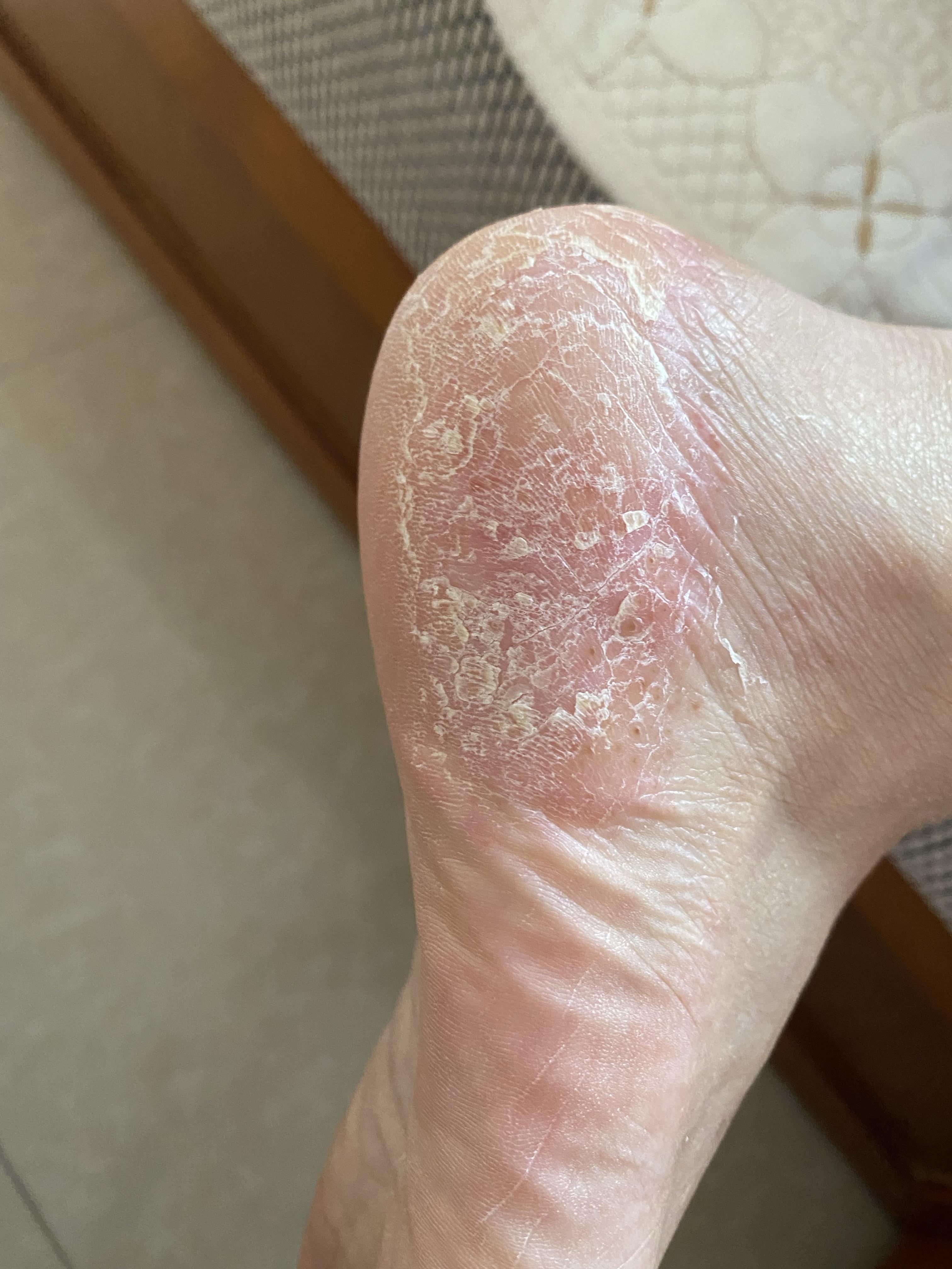 爱吃芒果的傻菇凉 的想法: 脚上总是起皮 小疱疹 有时会痛 请问有没有
