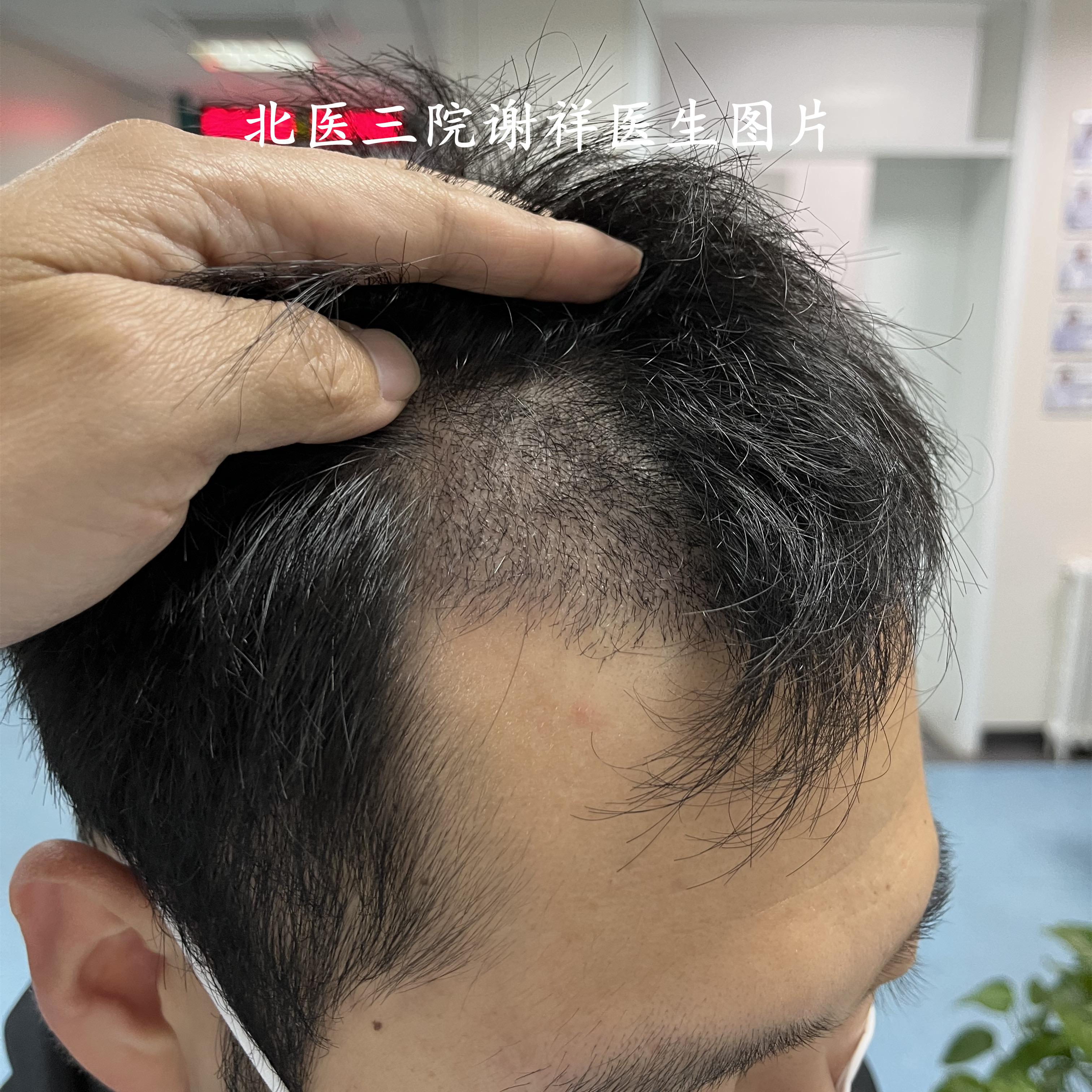 谢祥的植发世界 的想法: 植发术后16天复查,额角植发区基本能被头发遮盖,后枕部取发区也长长了,去理发馆修一下周围头发就很好看了。 #植发手术 ...