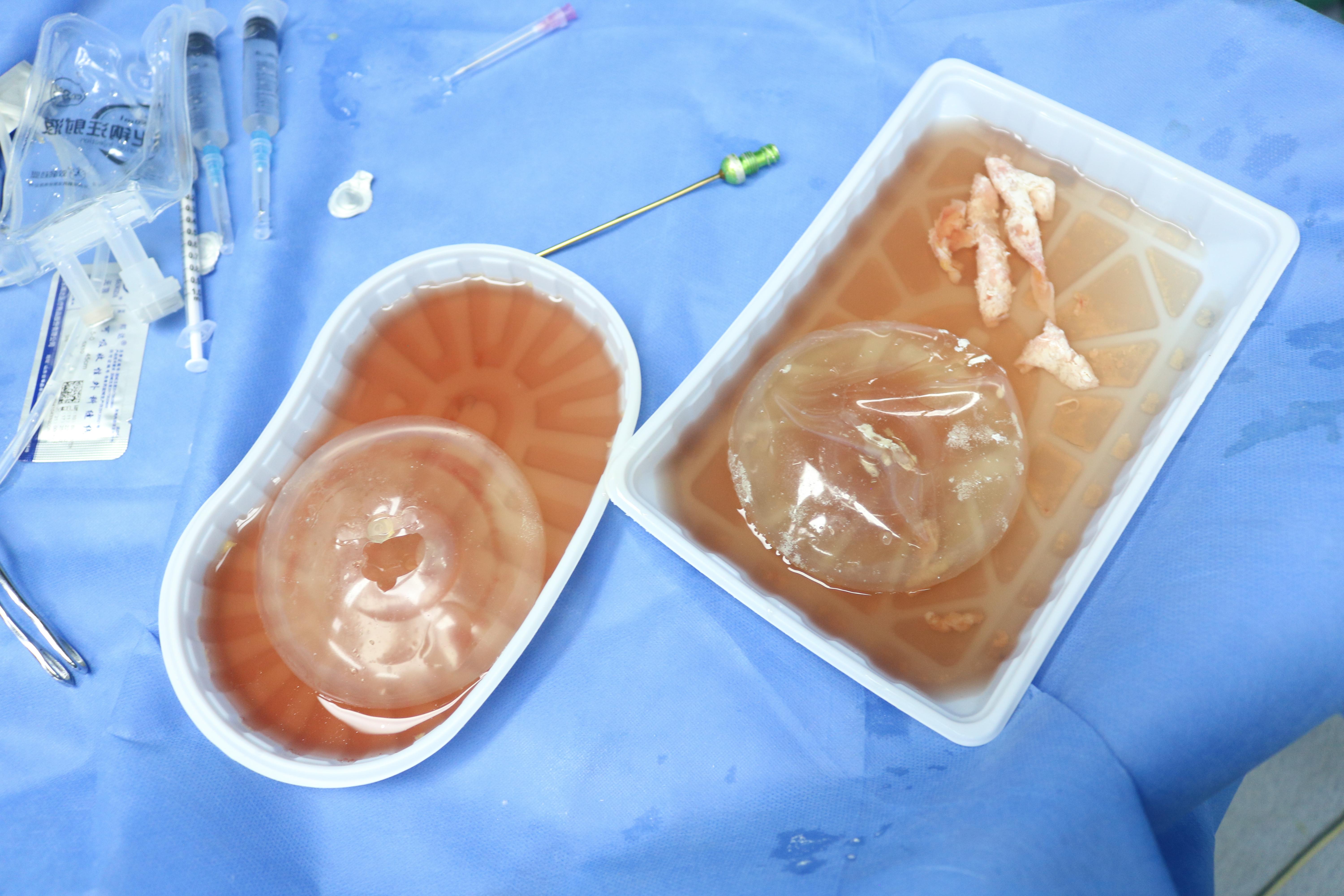 隆胸医生刘成胜 的想法: 15年前在香港做的盐水袋隆胸