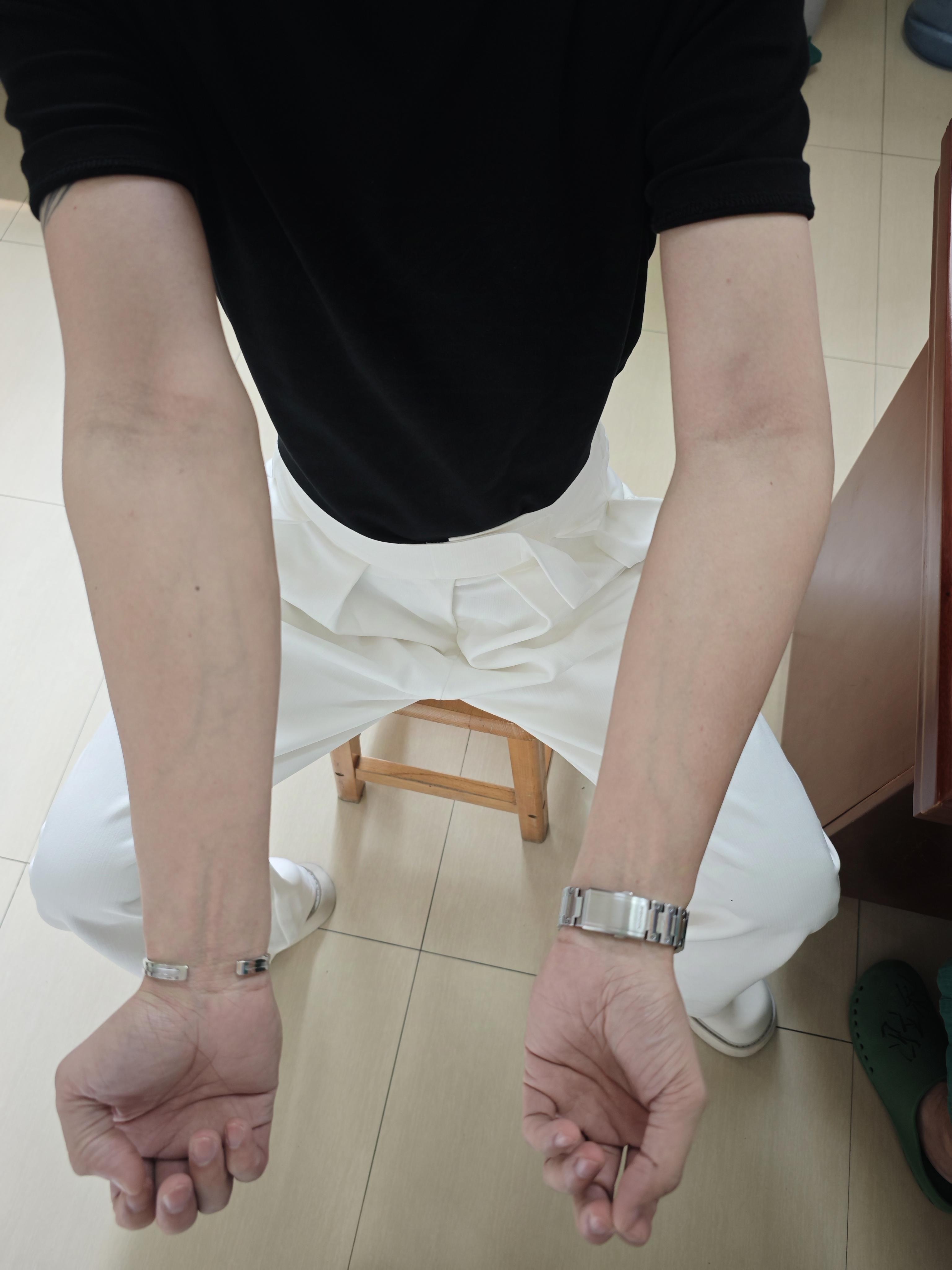 冯 的想法: 肘内翻畸形矫形前后对比