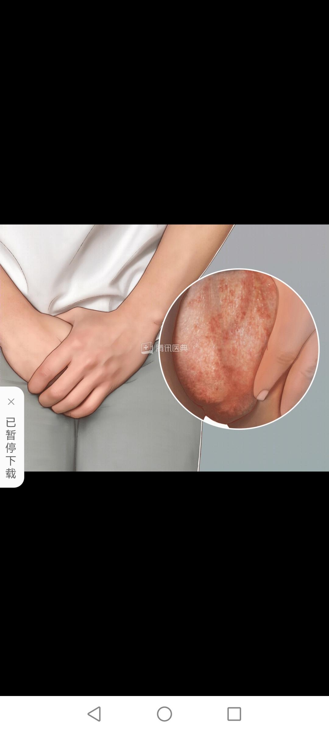 杨洋洋啊 的想法: 本人25岁,家在广西,男性未婚,20岁得的阴囊湿疹