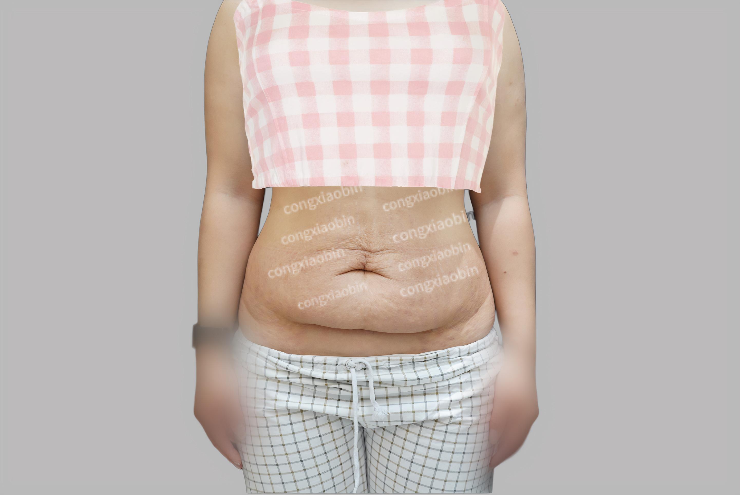 大撑裂了皮肤肚子上留下了大量妊娠纹产后腹部皮肤严重下垂整个肚子就