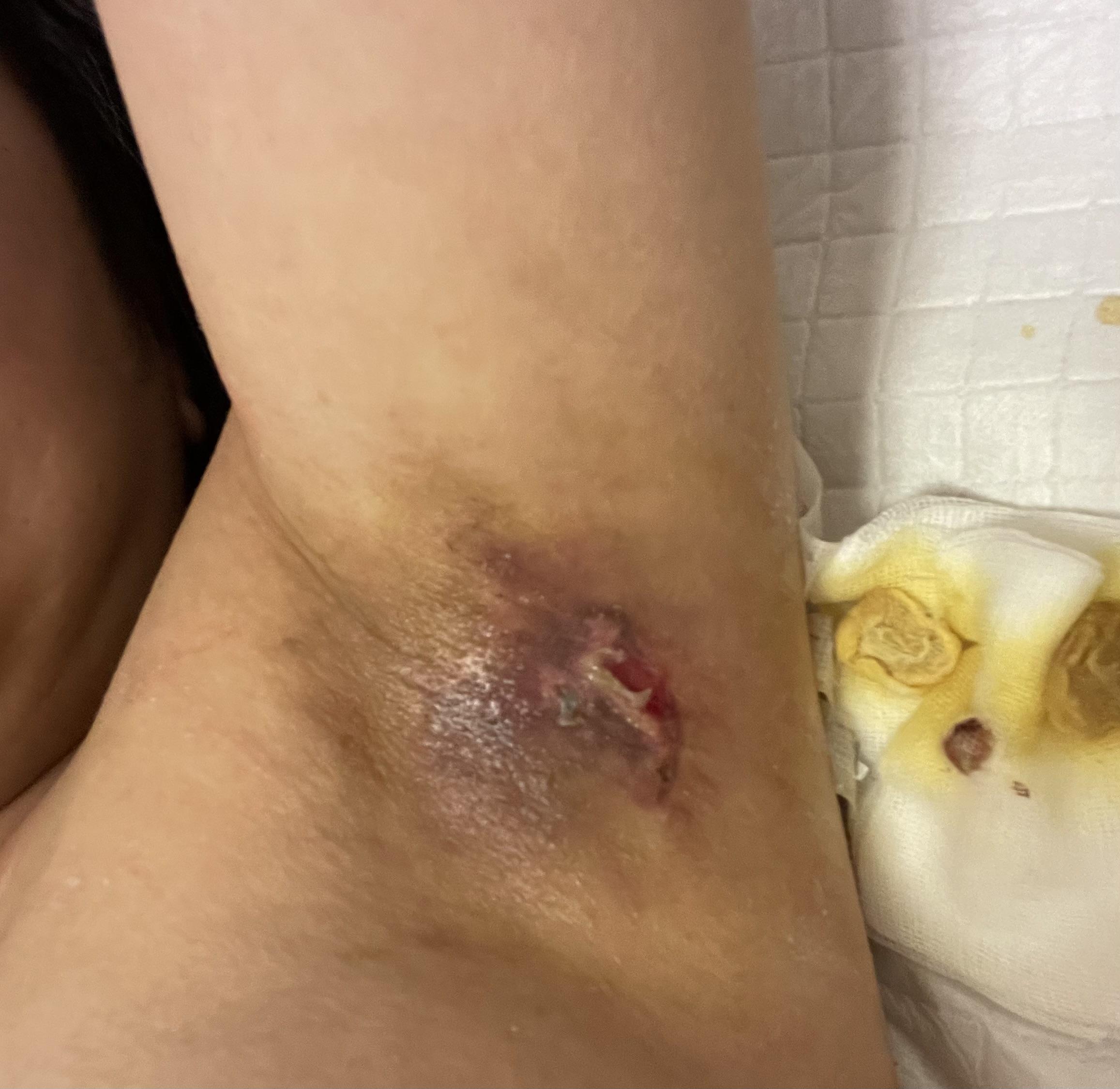 轻烟 的想法: 腋臭微创手术恢复整整一个月的状态图