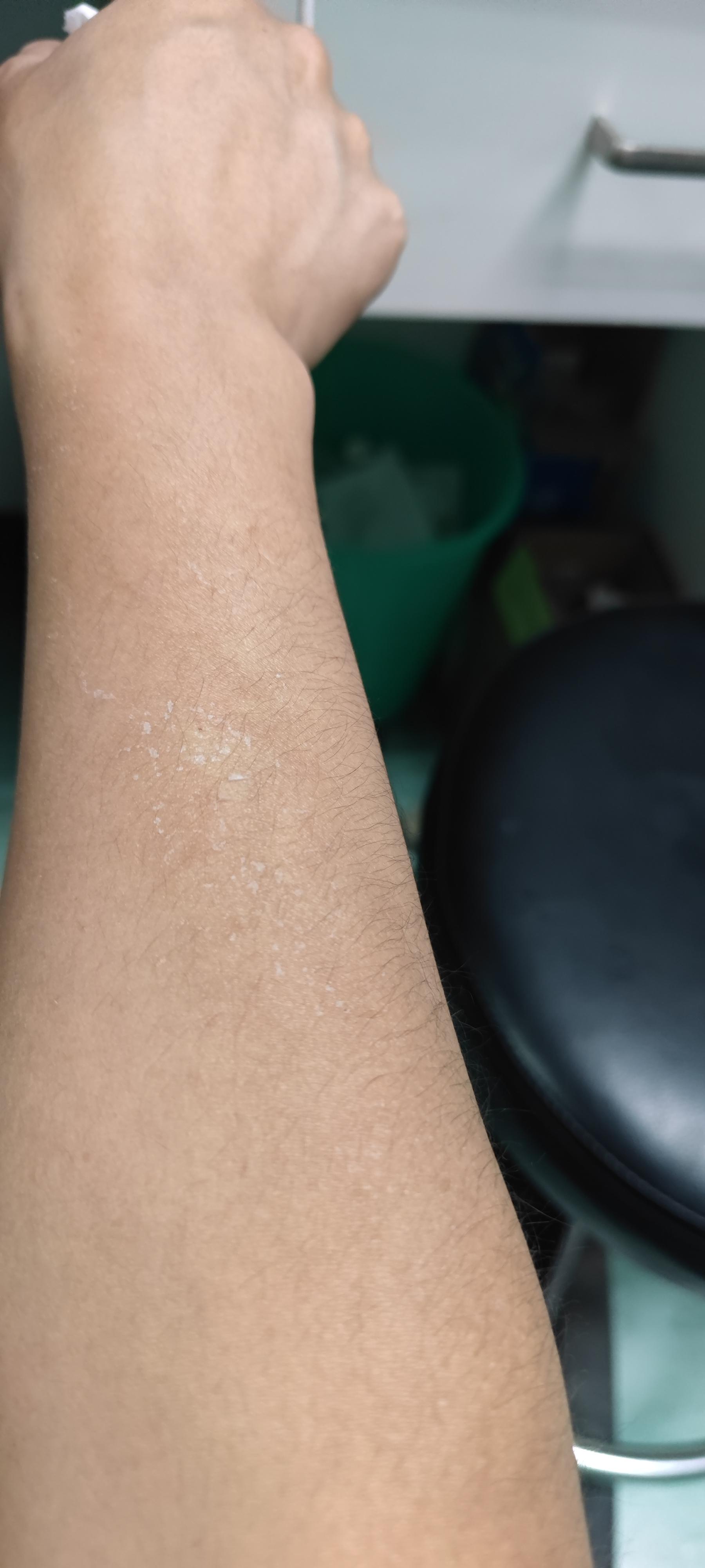 星空 的想法: 手臂为什么蜕皮啊,第一次哎,薄薄一层慢慢掉