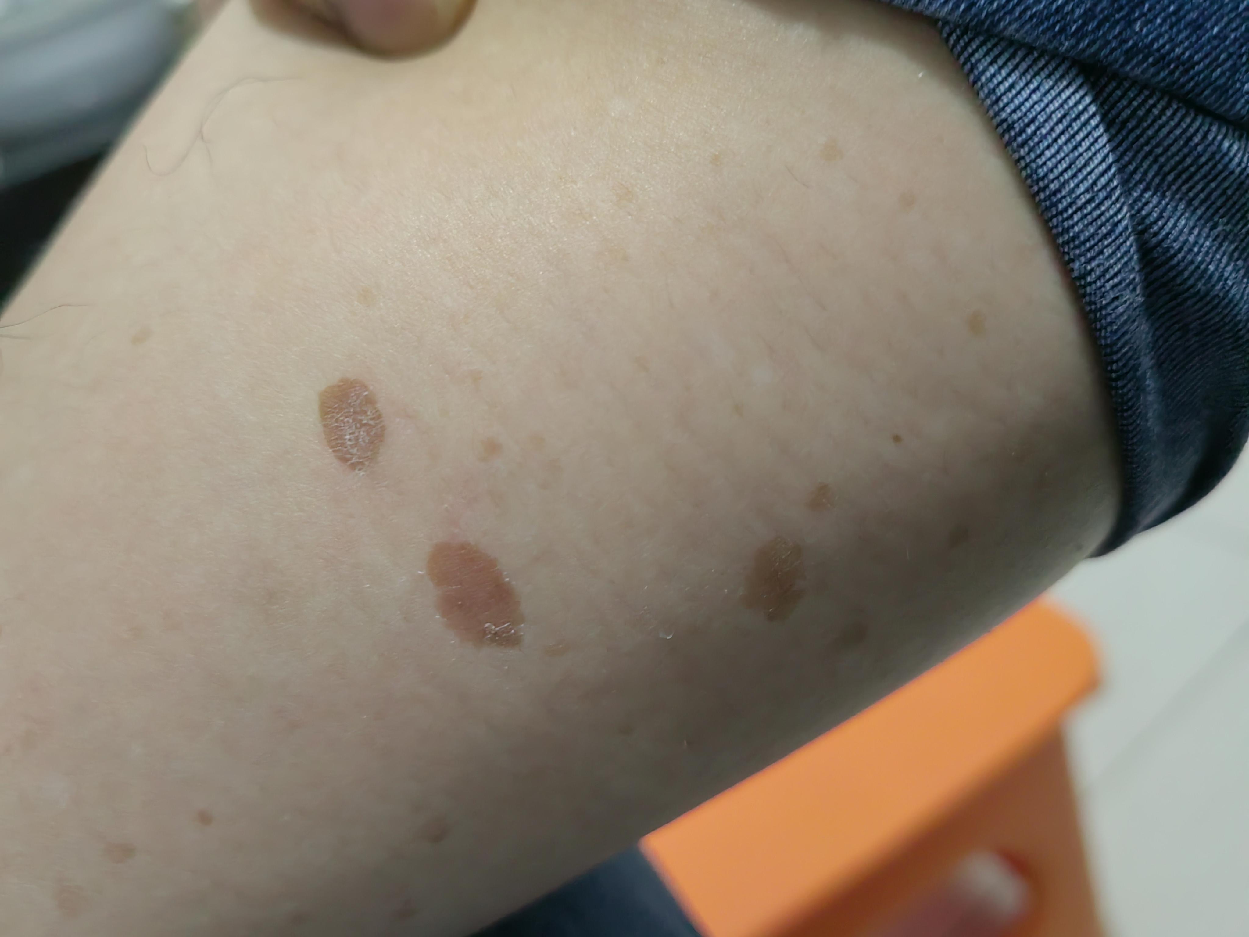 水泊君 的想法: 腿上长斑是什么问题