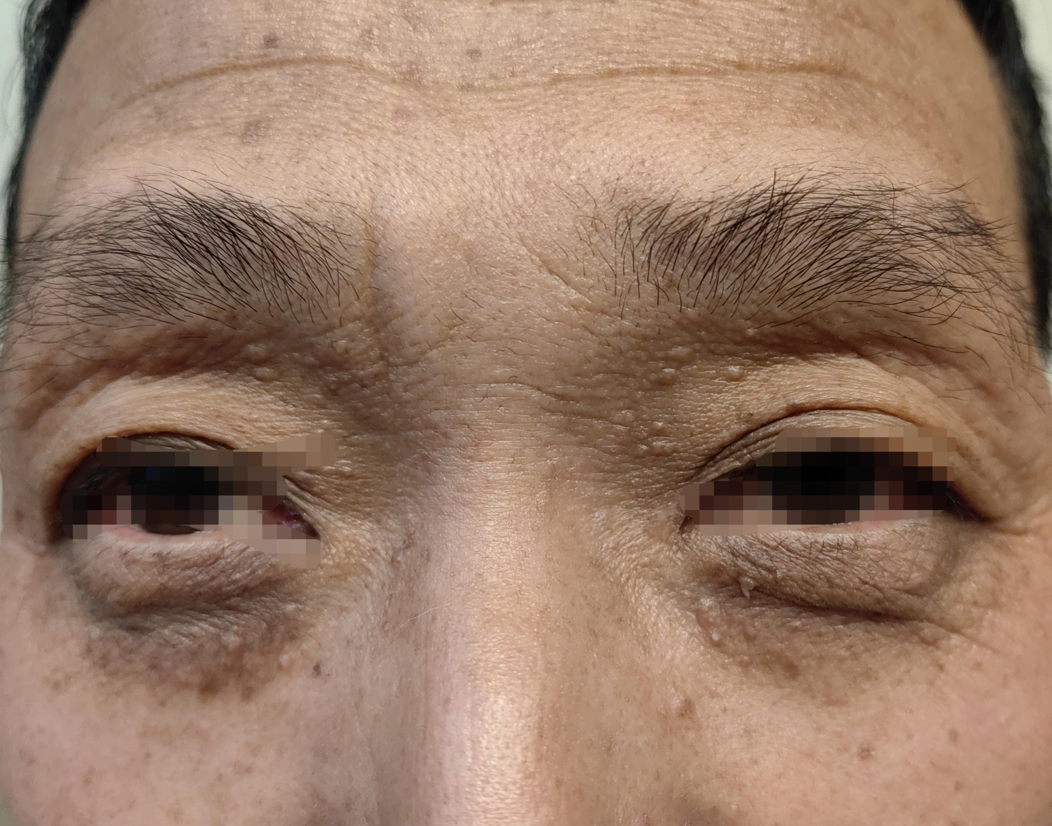 护肤在西塘 的想法: 黑眼圈,小疙瘩,眼周衰老怎么办?