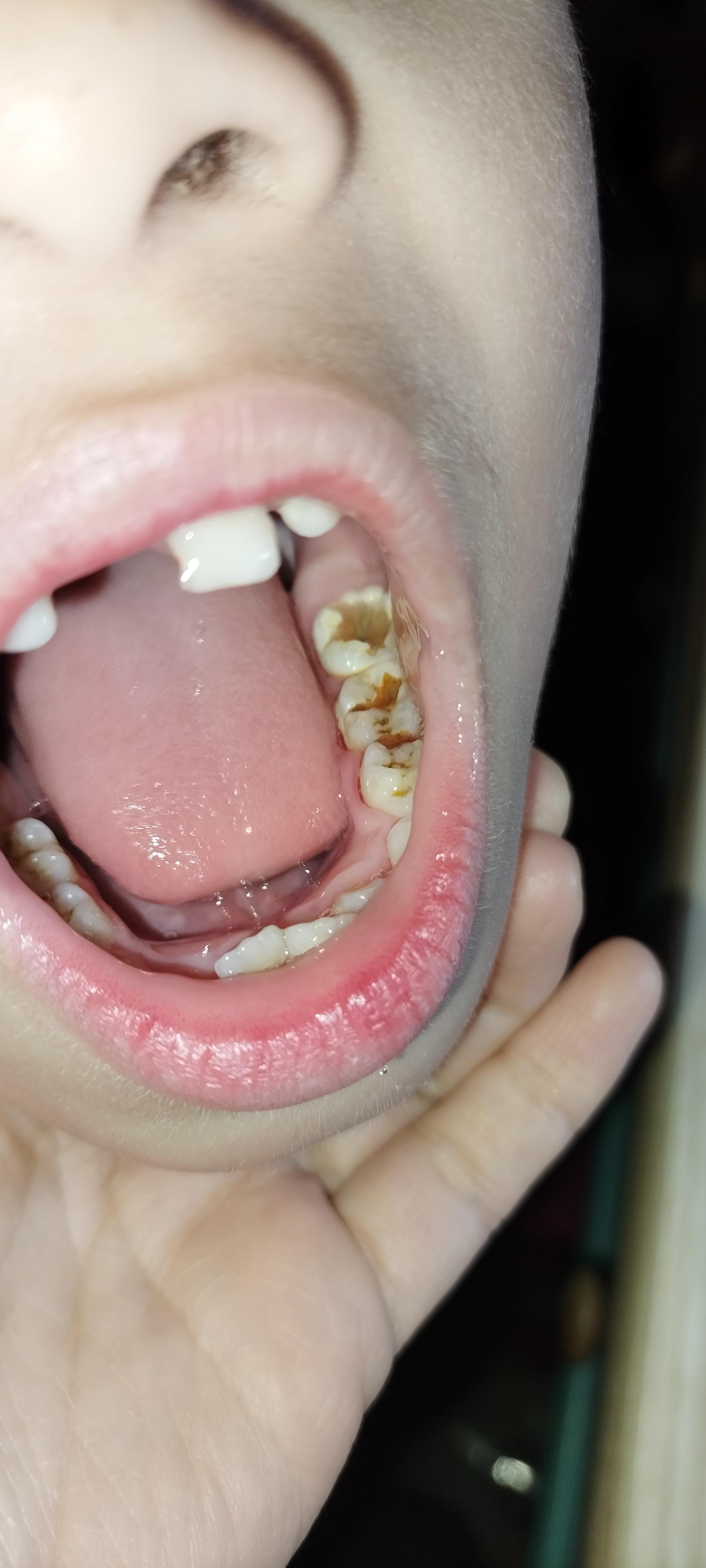 六岁宝宝牙,吃夜奶,喜欢吃甜品,一不小心就得龋齿