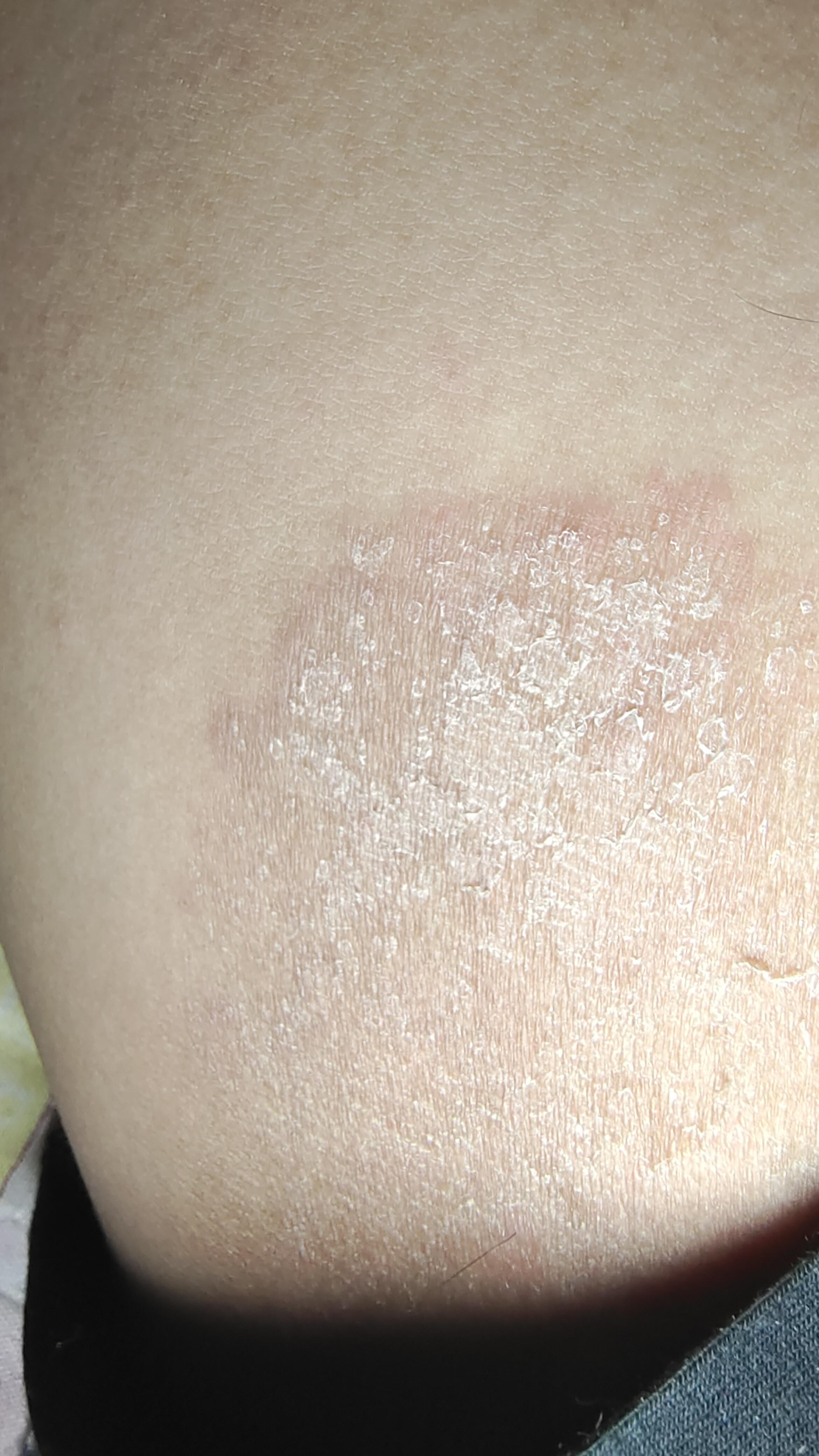 家人们,有没有懂皮肤病的呀,大腿根部,特别痒,有