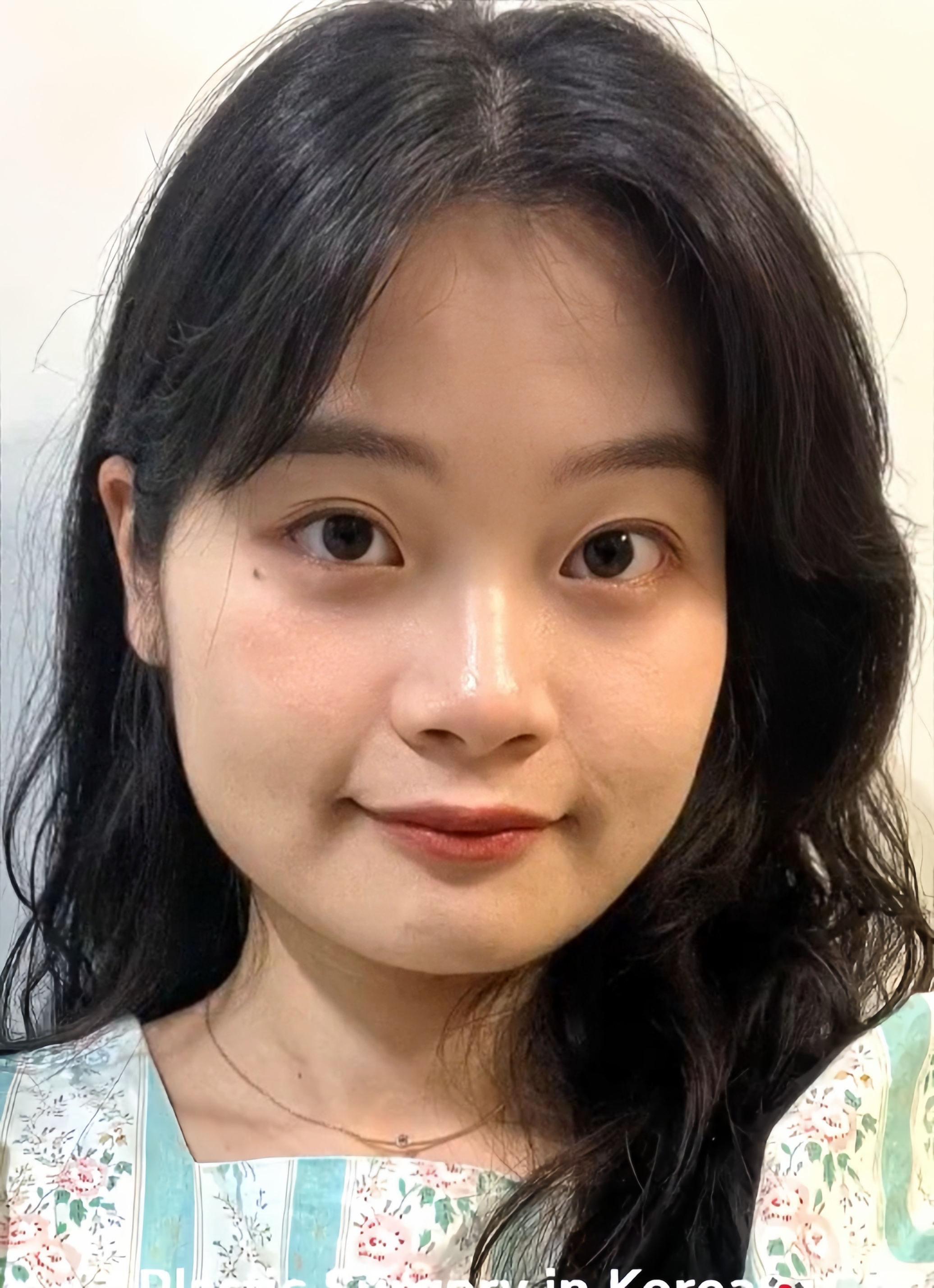  脸大的原因有骨性的,软组织性的,要分析清楚才能够有针对性