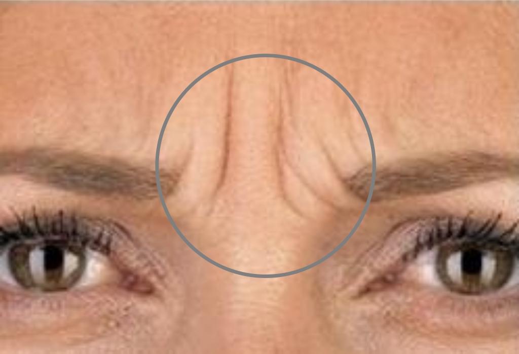 显出衰老而沧桑的感觉,川字纹就是面