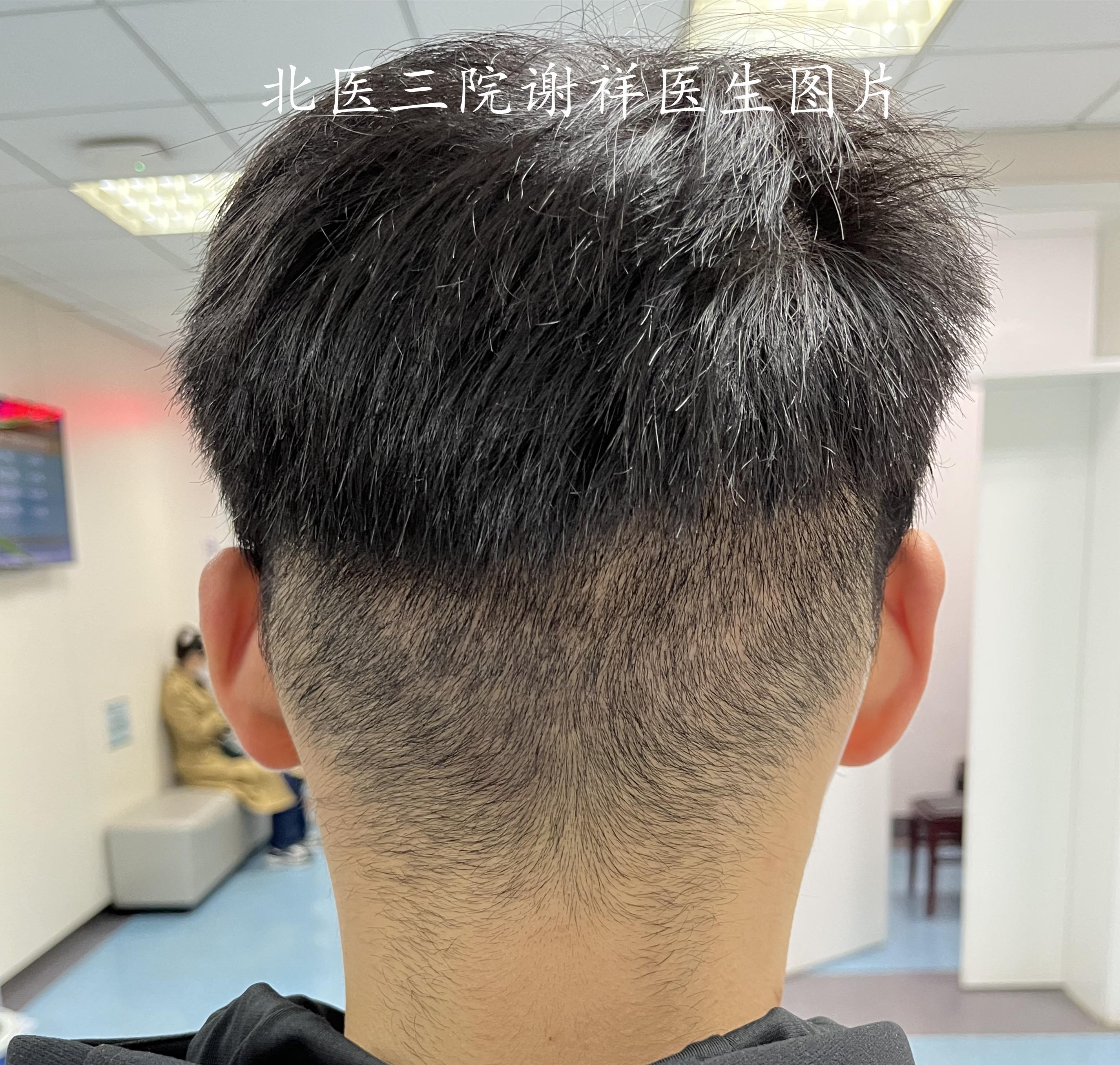 谢祥的植发世界 的想法: 植发术后16天复查,额角植发区基本能被头发遮盖,后枕部取发区也长长了,去理发馆修一下周围头发就很好看了。 #植发手术 ...