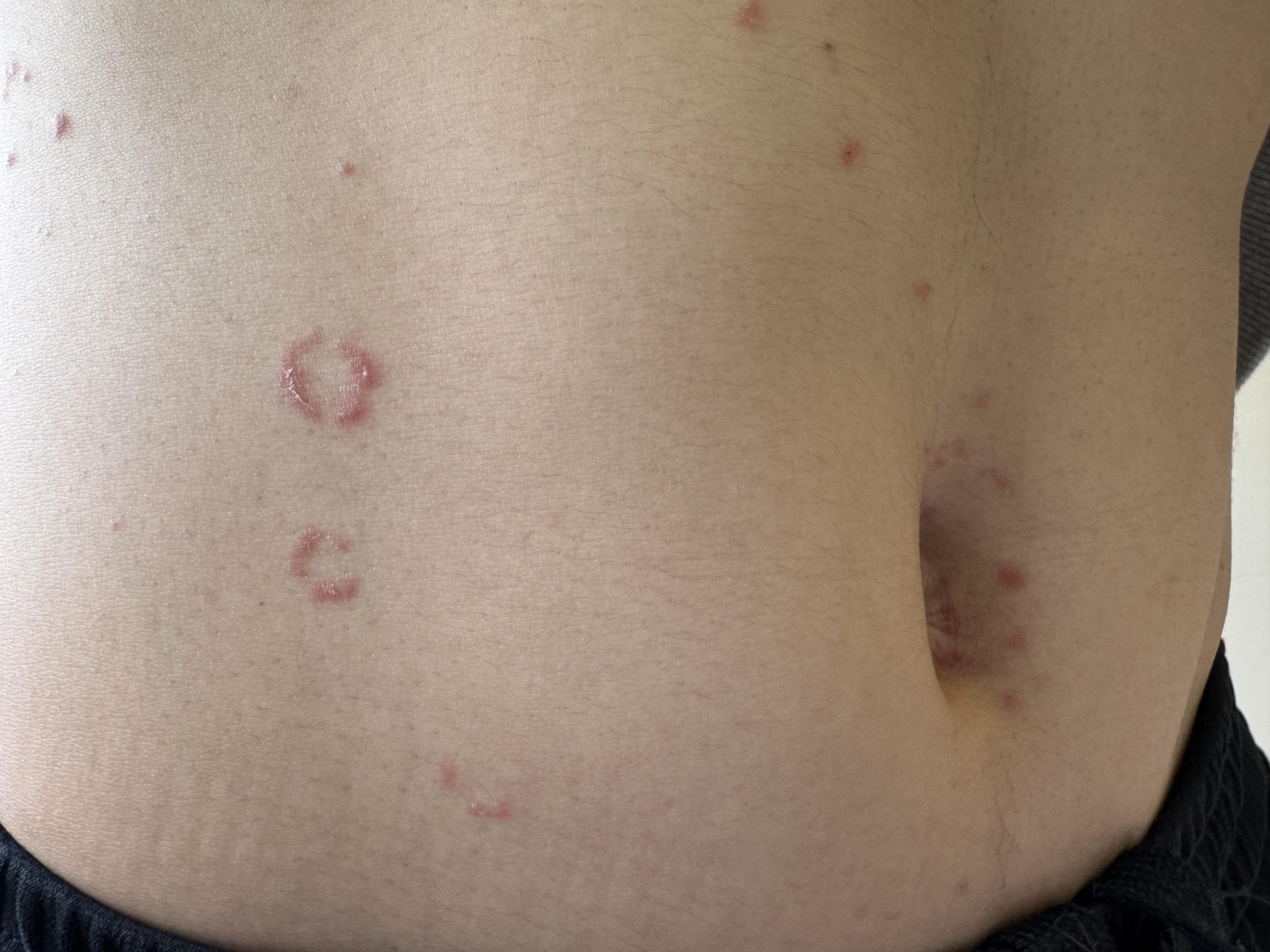 环状皮损未必是铜钱癣这位小伙子躯干四肢很多环状红色